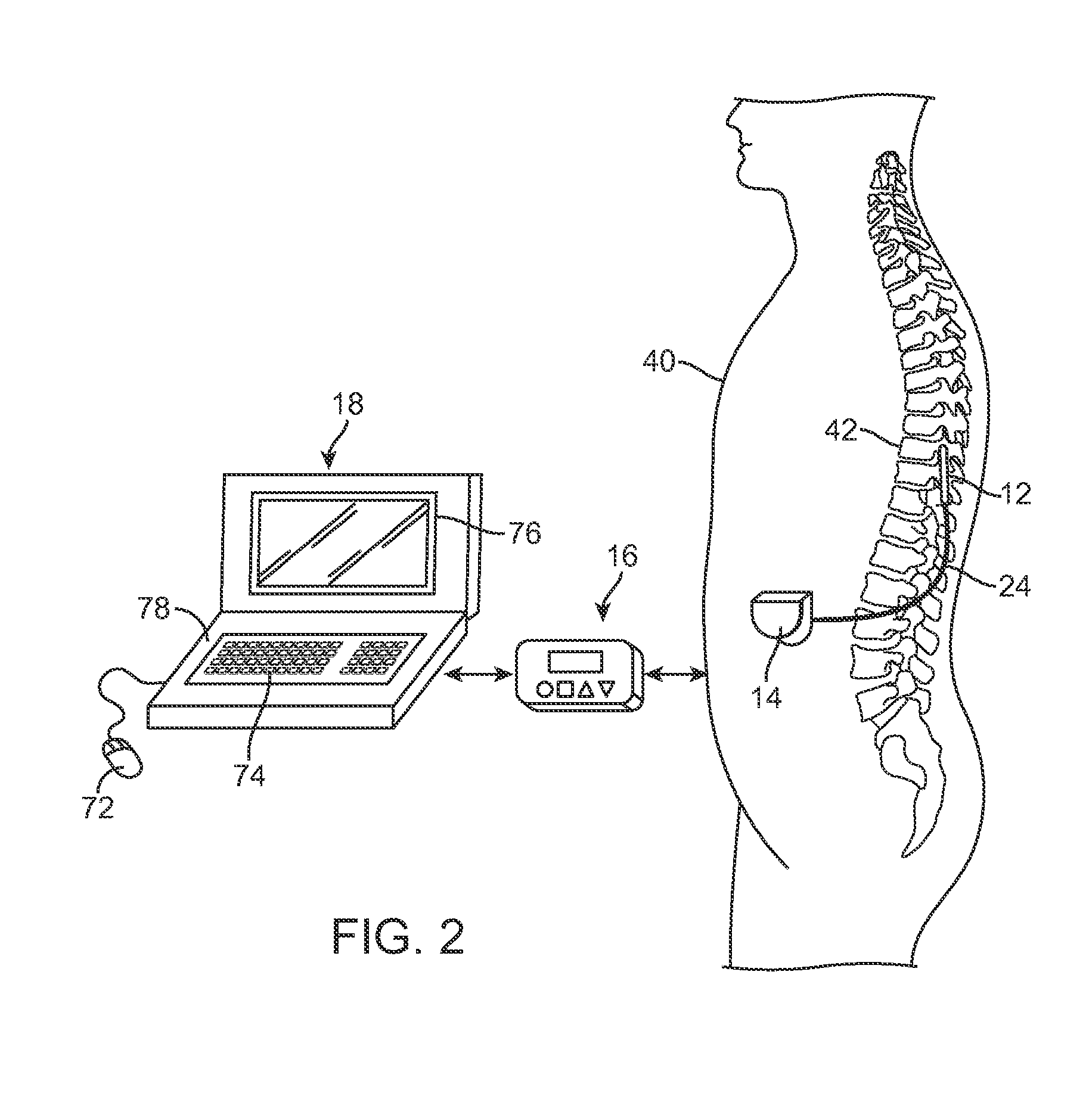 Systems and methods for delivering sub-threshold therapy to a patient at a physiological midline