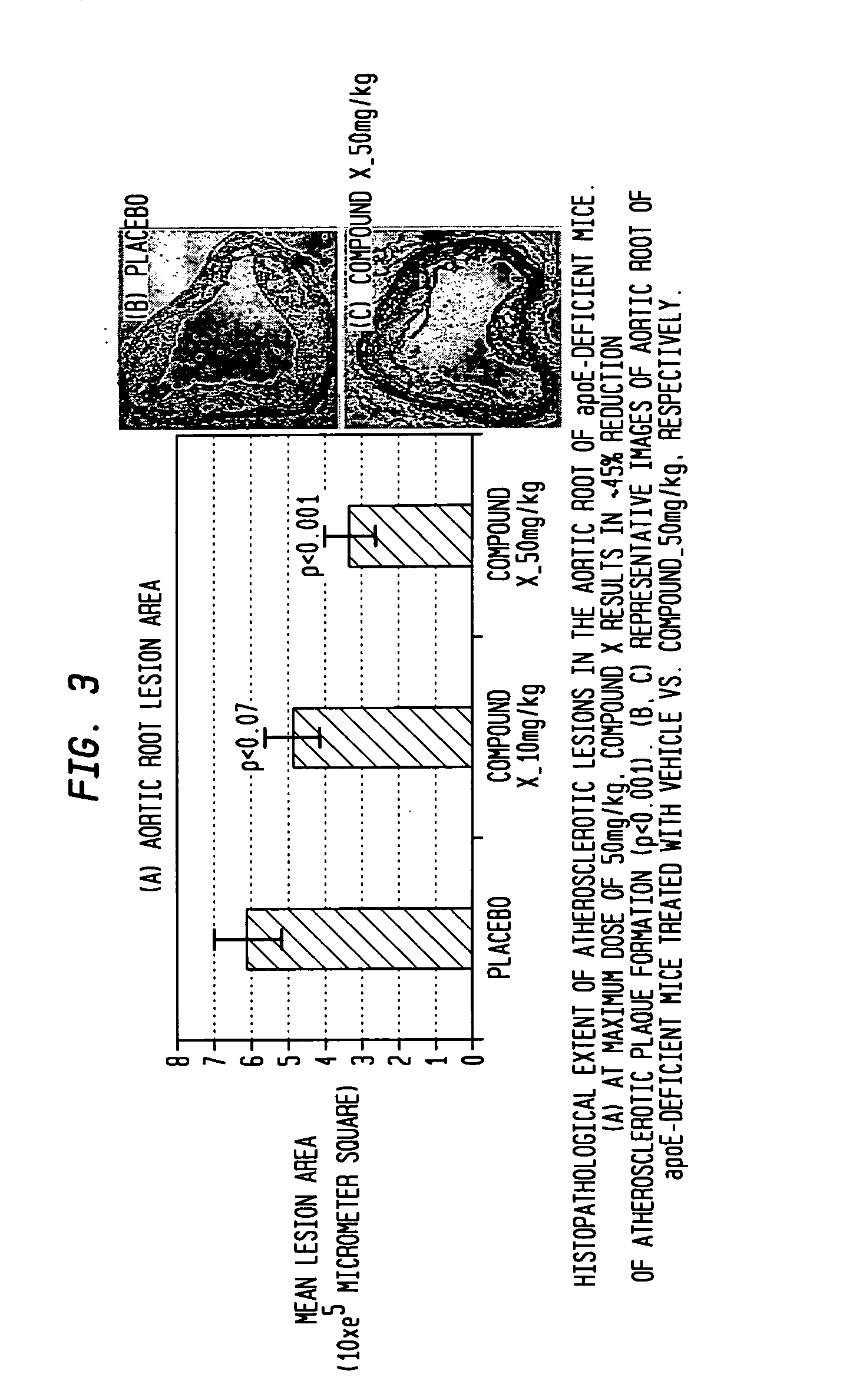 Phenylalkyl N-hydroxyureas for combating atherosclerotic plaque