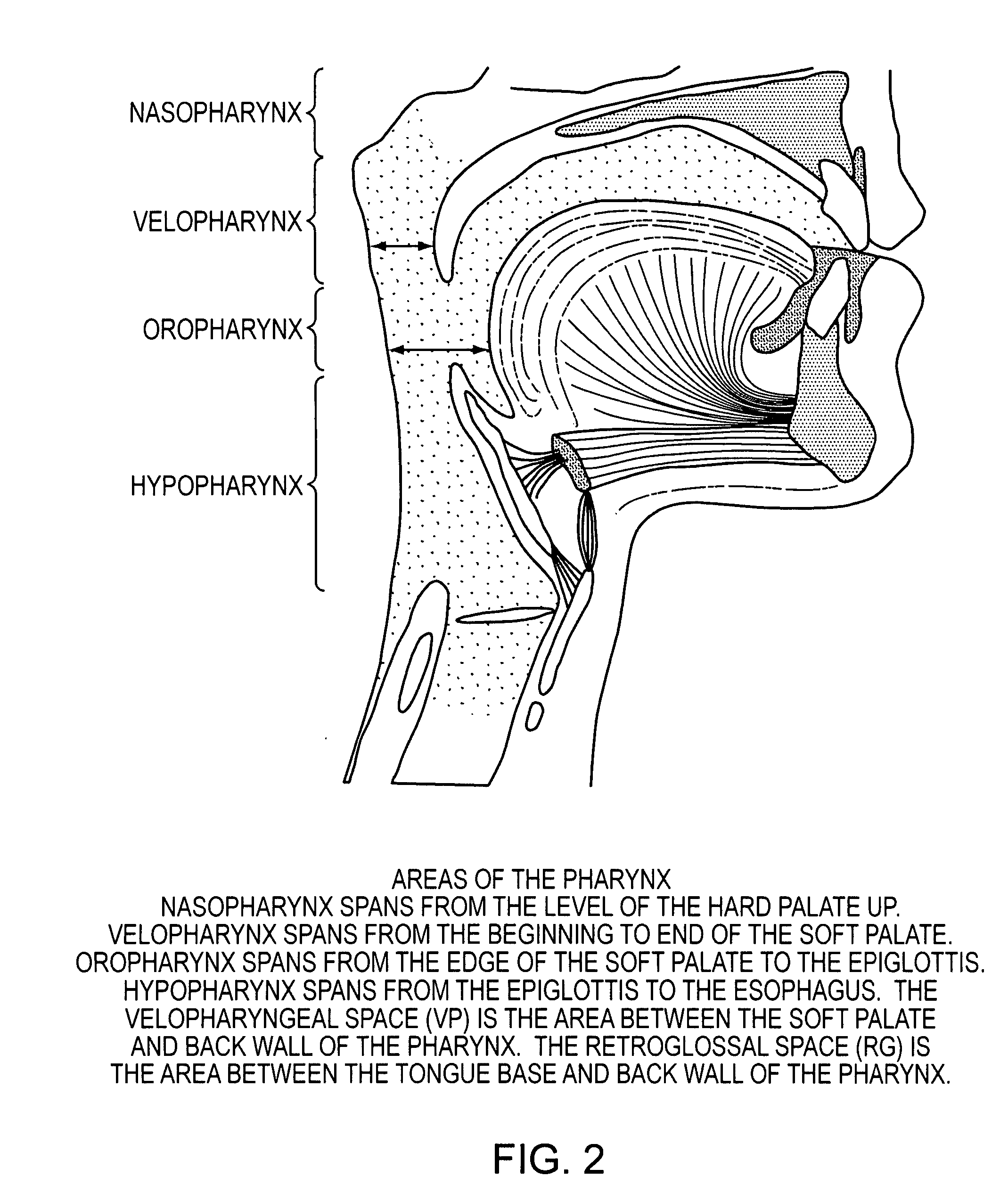 Methods and Devices for Treating Sleep Apnea and Snoring