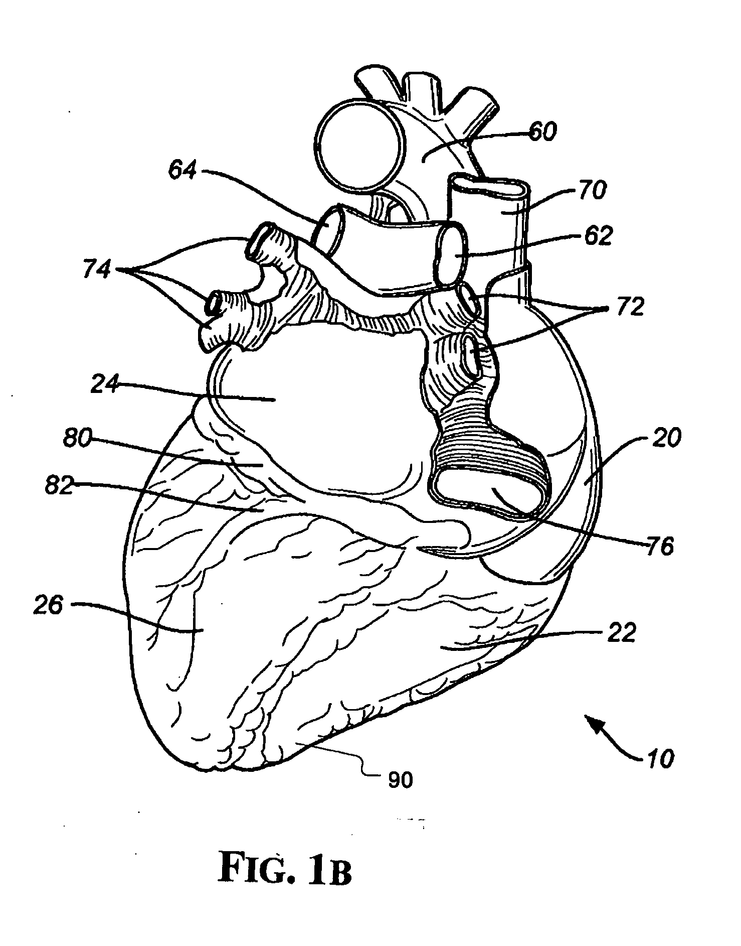 Implantable Micro-Generator Devices with Optimized Configuration, Methods of Use, Systems and Kits Therefor