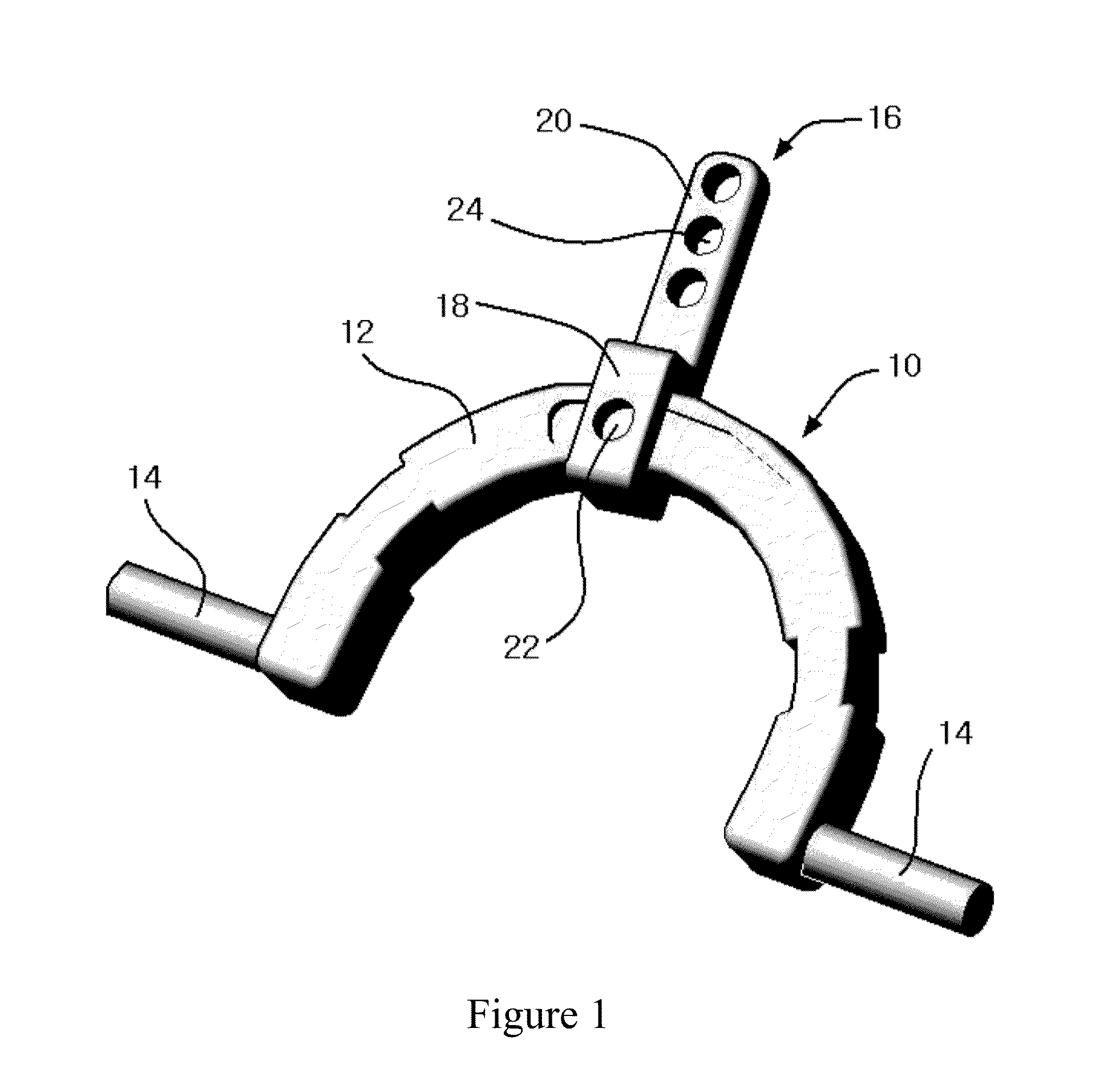 Apparatus for Occipital-Cervical Fixation Enabling Supplemental Occipital Bone Fixation