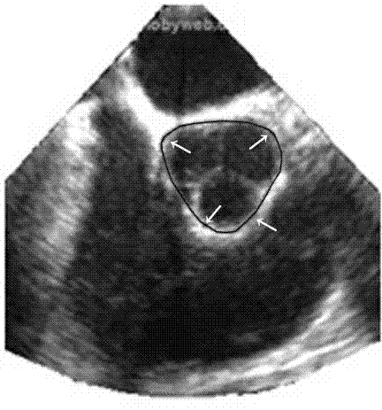 Aortic valve fast segmentation method based on esophageal echocardiography