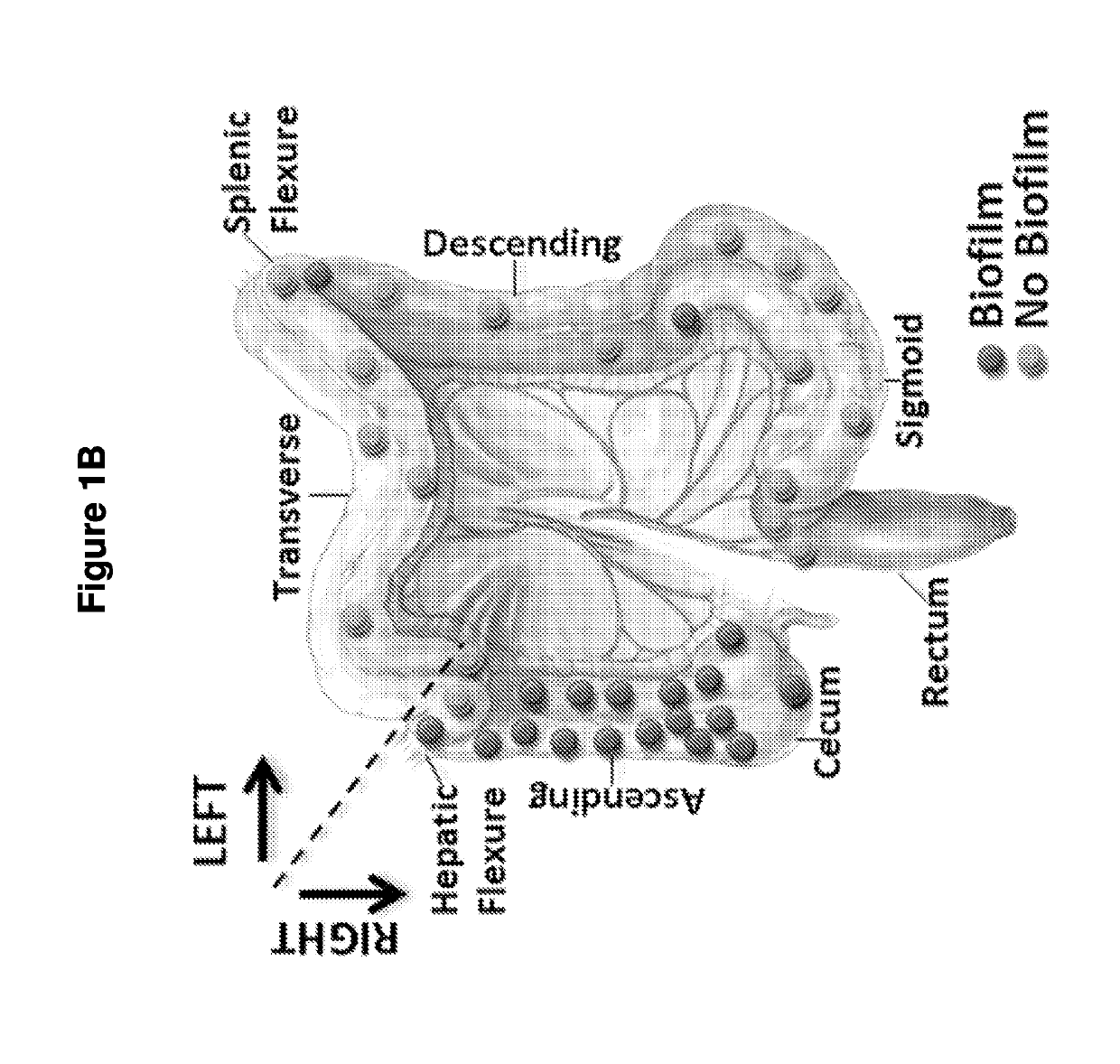 Biofilm formation to define risk for colon cancer