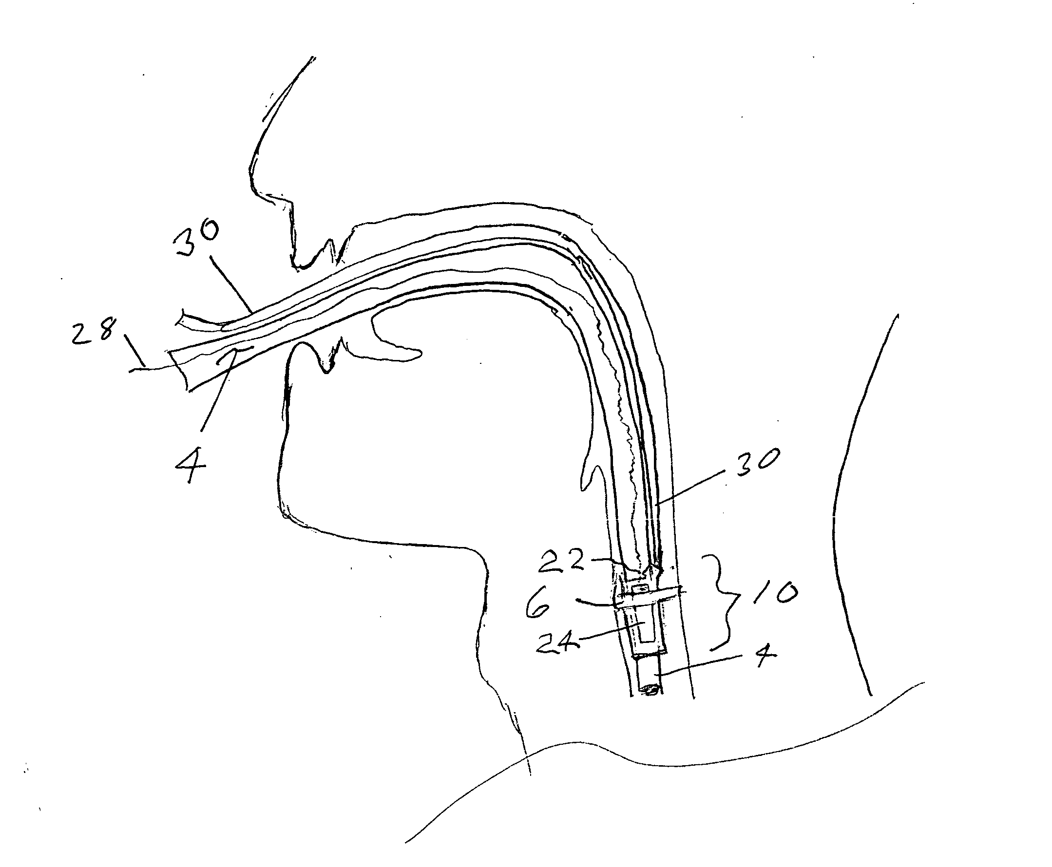 Endotracheal electrode and optical positioning device