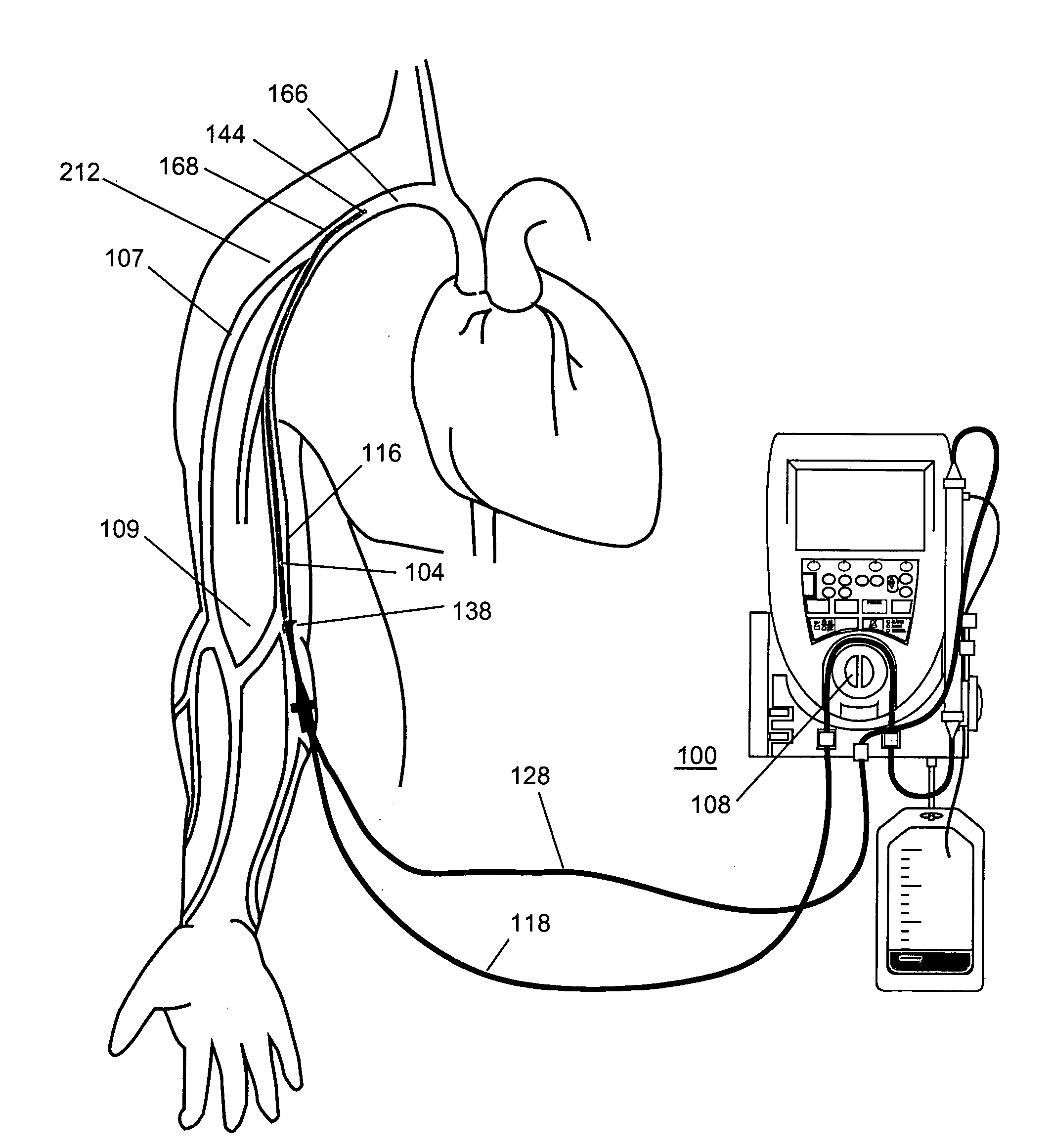 Method and apparatus for ultrafiltration utilizing a peripheral access dual lumen venous cannula