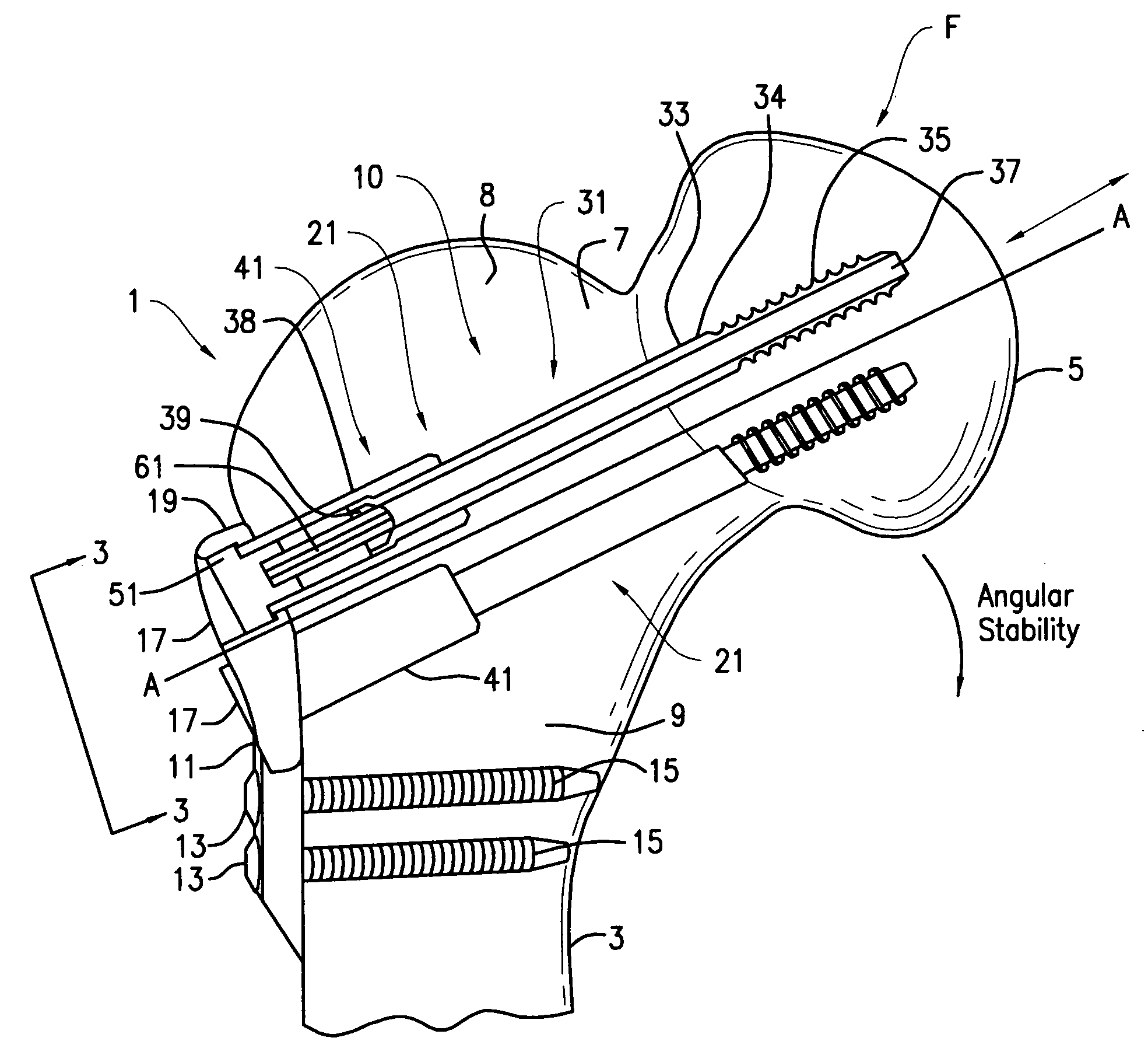 Hip fracture device with barrel and end cap for load control