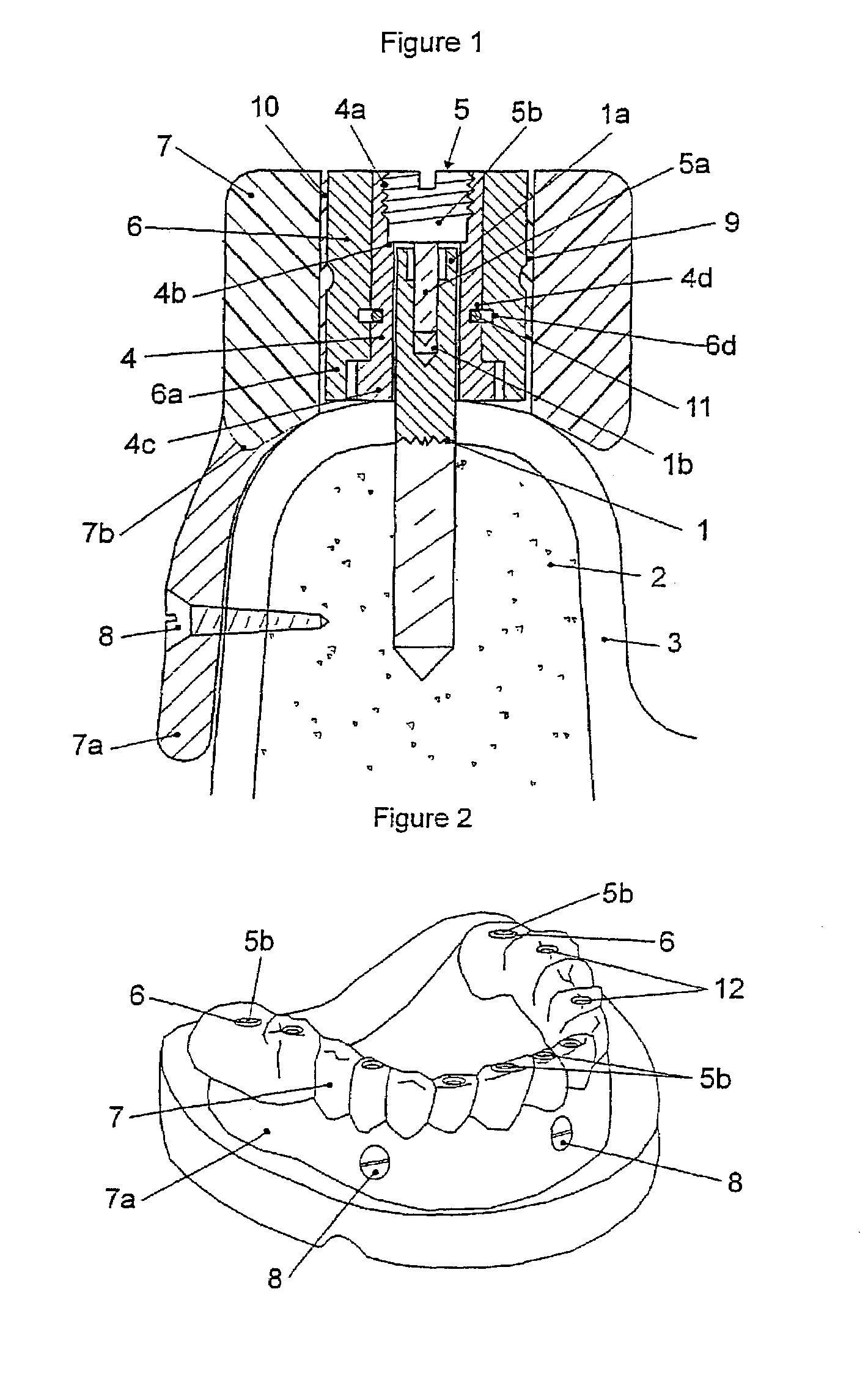 Positioning device for fitting implant-supported dental prostheses
