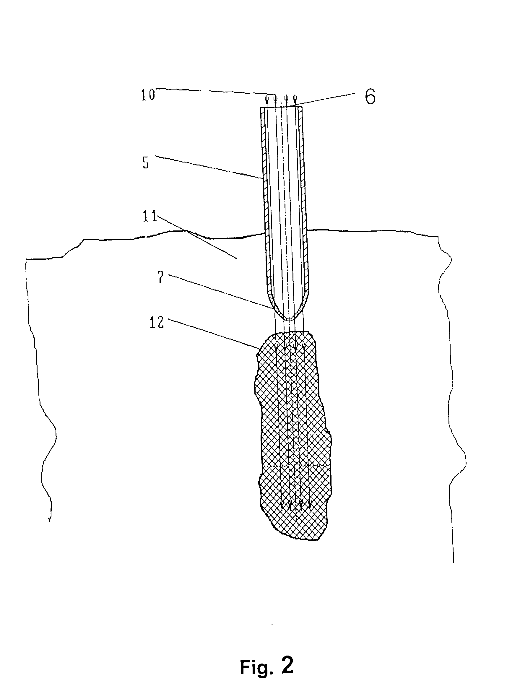 Device for radiation therapy