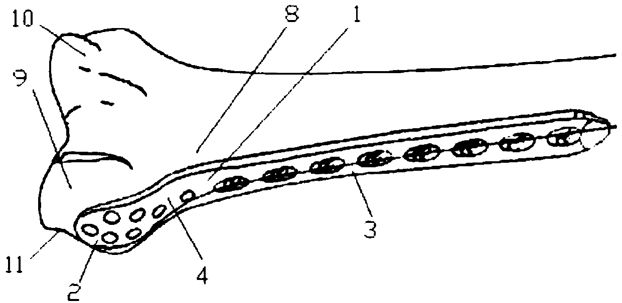 An anteromedial bone plate implanted in the distal femur