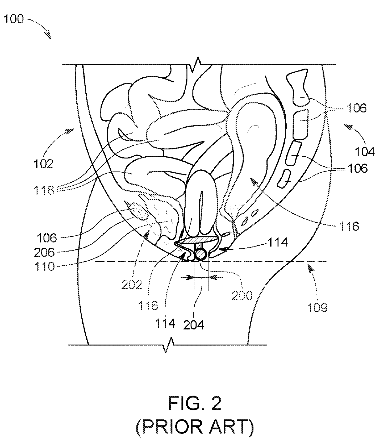 Pessary for pelvic organ prolapse