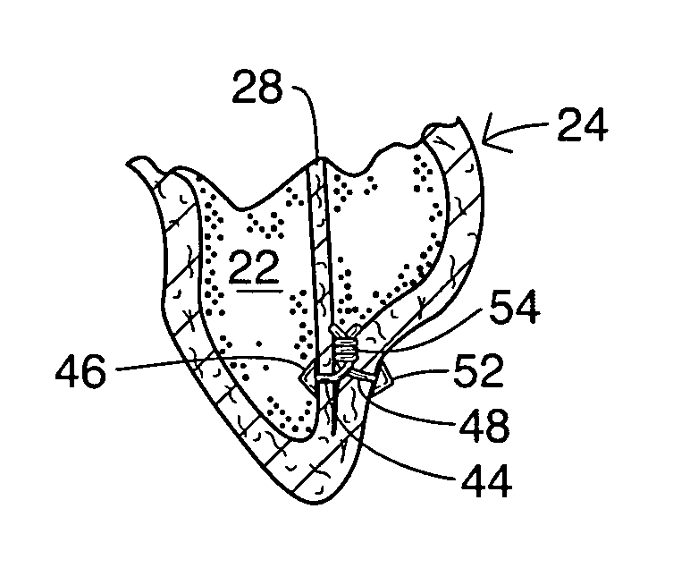 Method and device for improving cardiac function