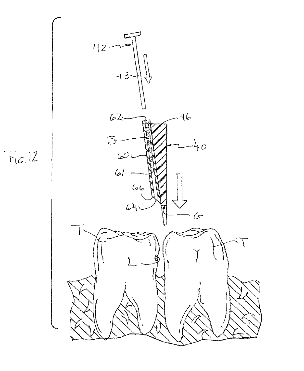 Wedge device for facilitating treatment of interproximal dental caries, and method of use
