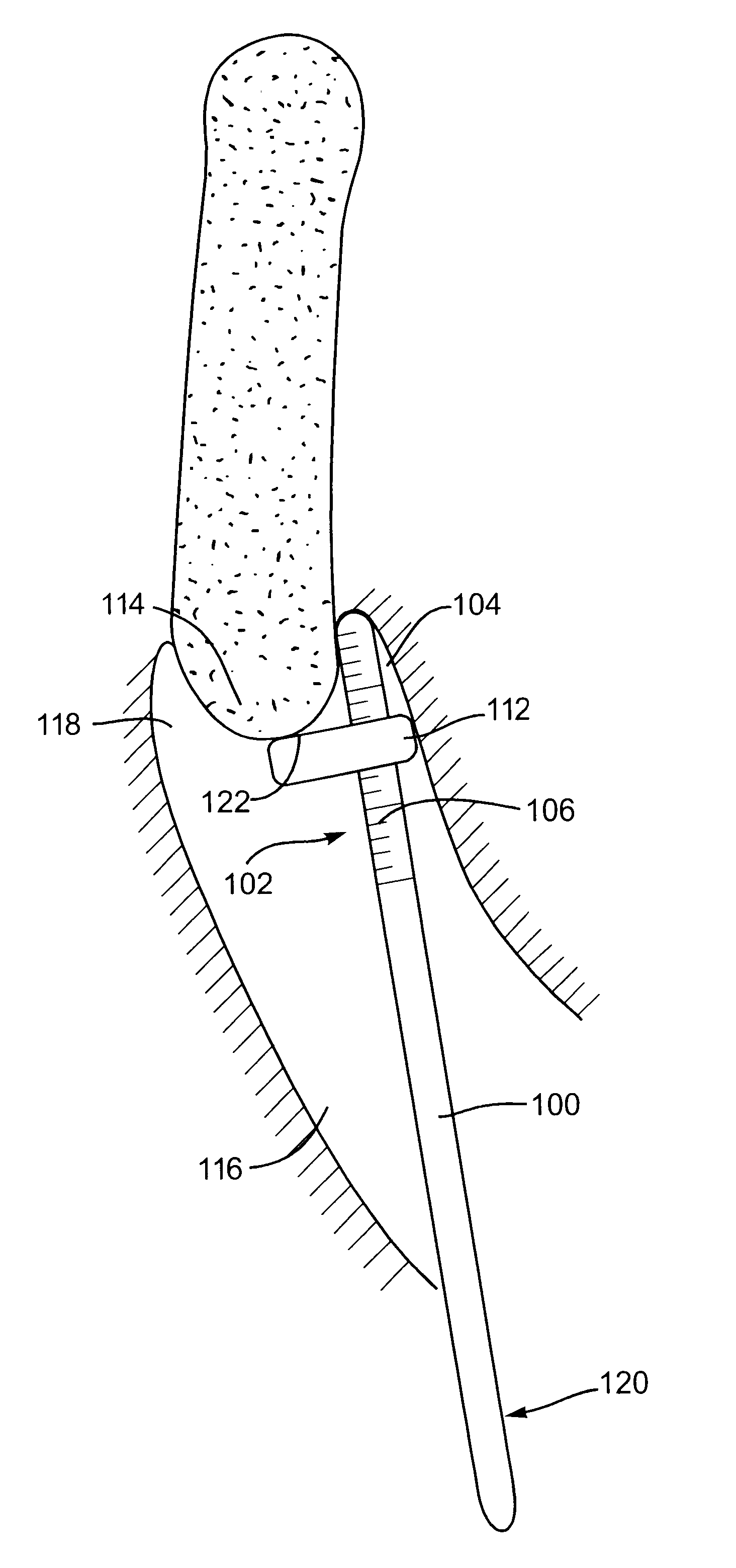 Devices and methods for cervix measurement