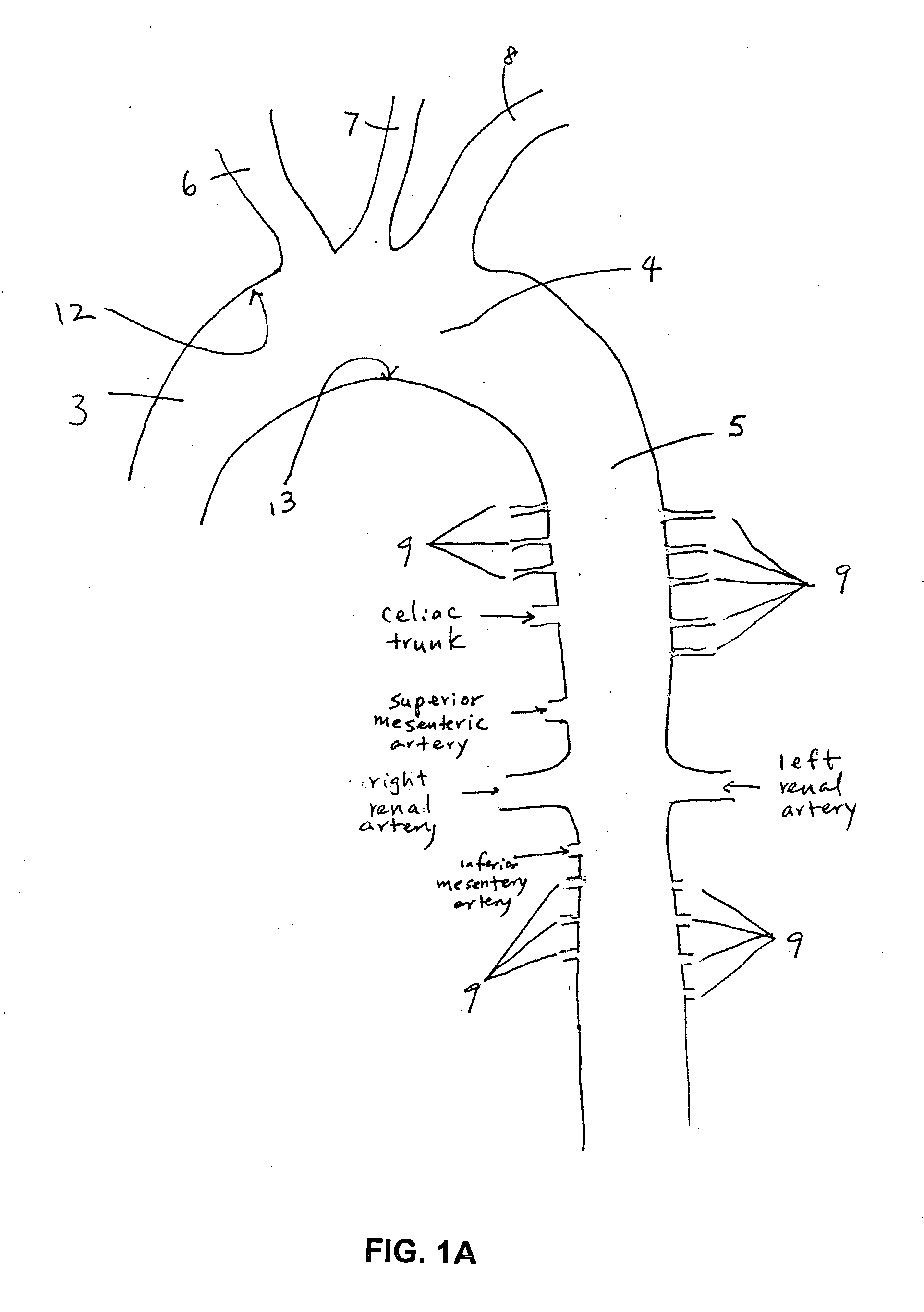 Implant for aortic dissection and methods of use