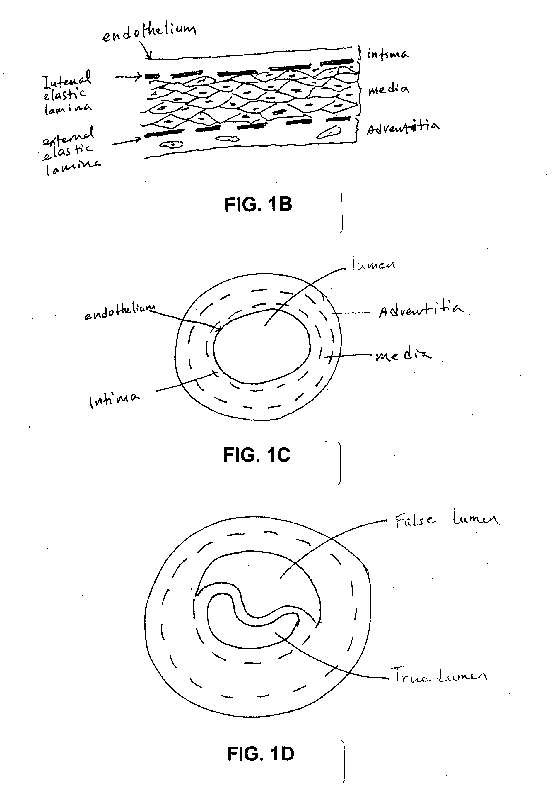 Implant for aortic dissection and methods of use