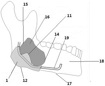 Inferior alveolar nerve protection guide plate based on mandible cystic lesion scaling