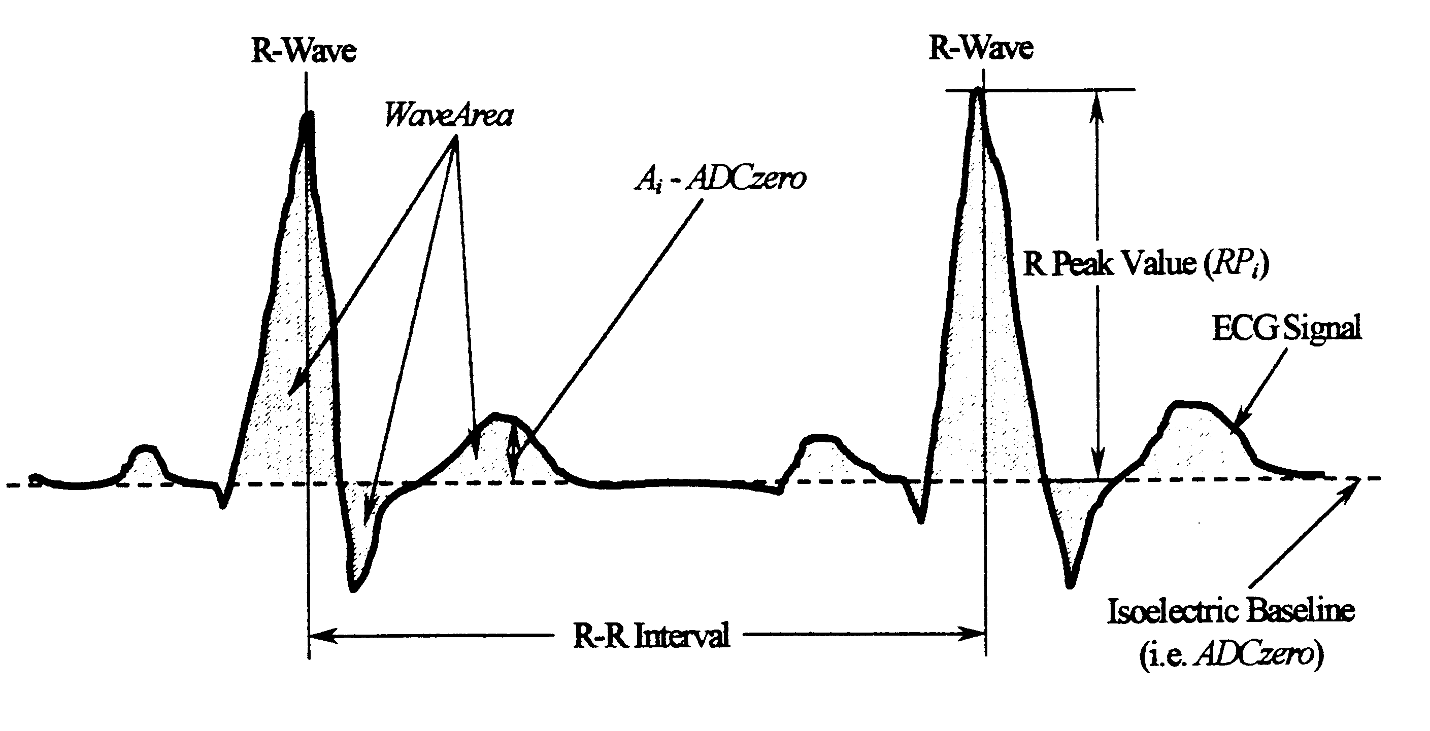 Cardiac arrhythmia detector using ECG waveform-factor and its irregularity