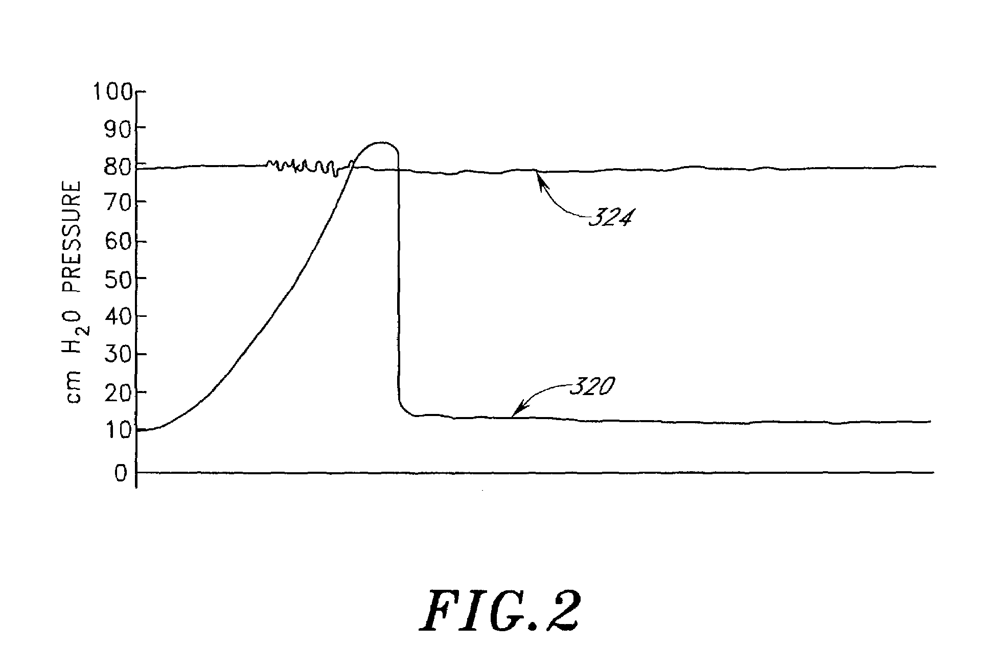 Treatment of patients with a compressible attenuation device