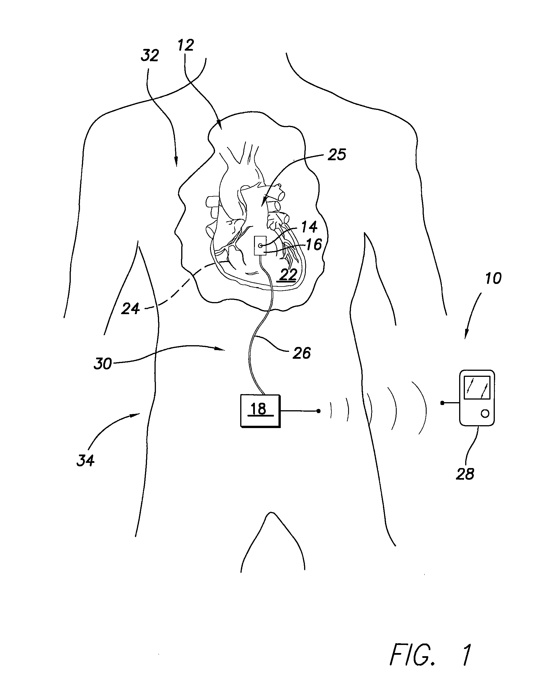 Implantable sensor for measuring physiologic information