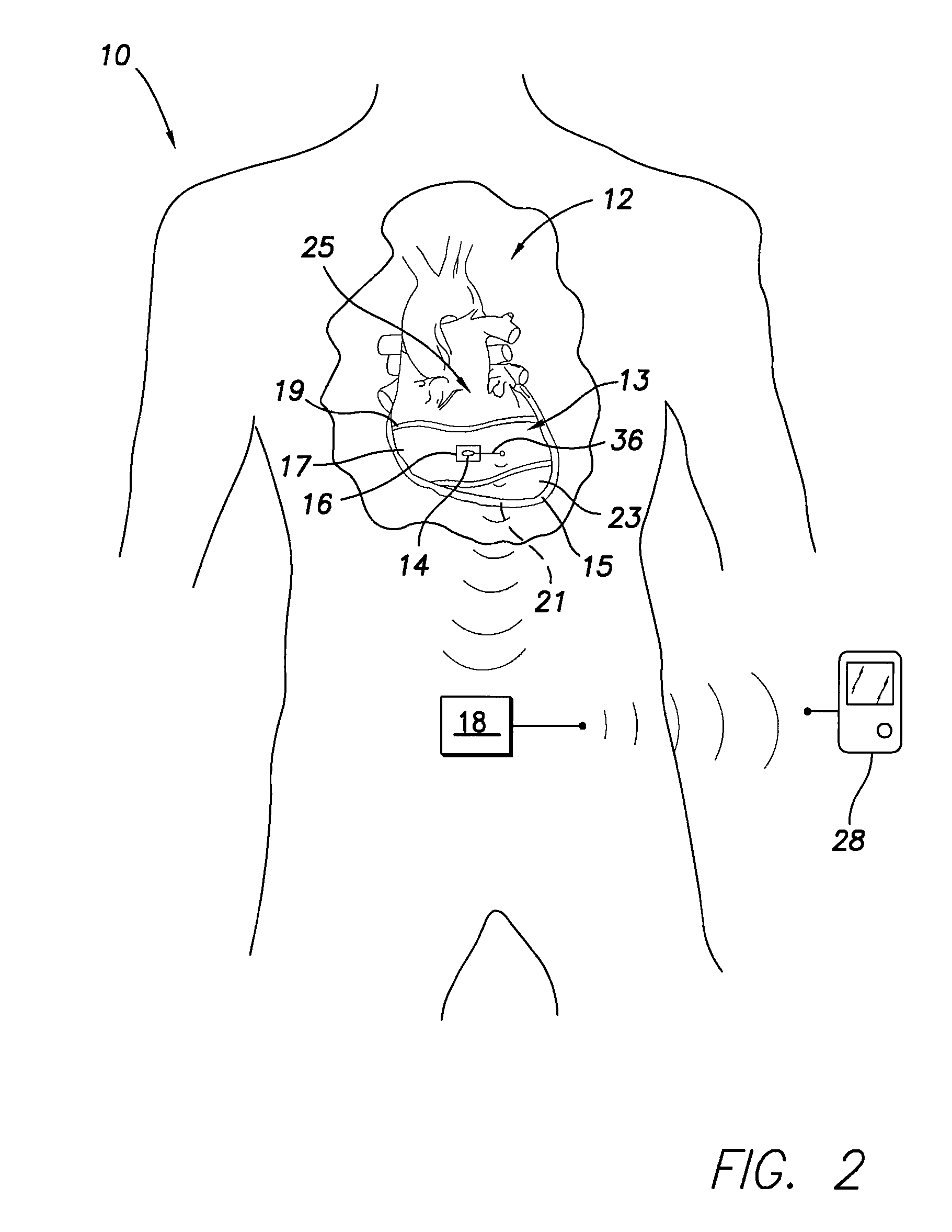 Implantable sensor for measuring physiologic information