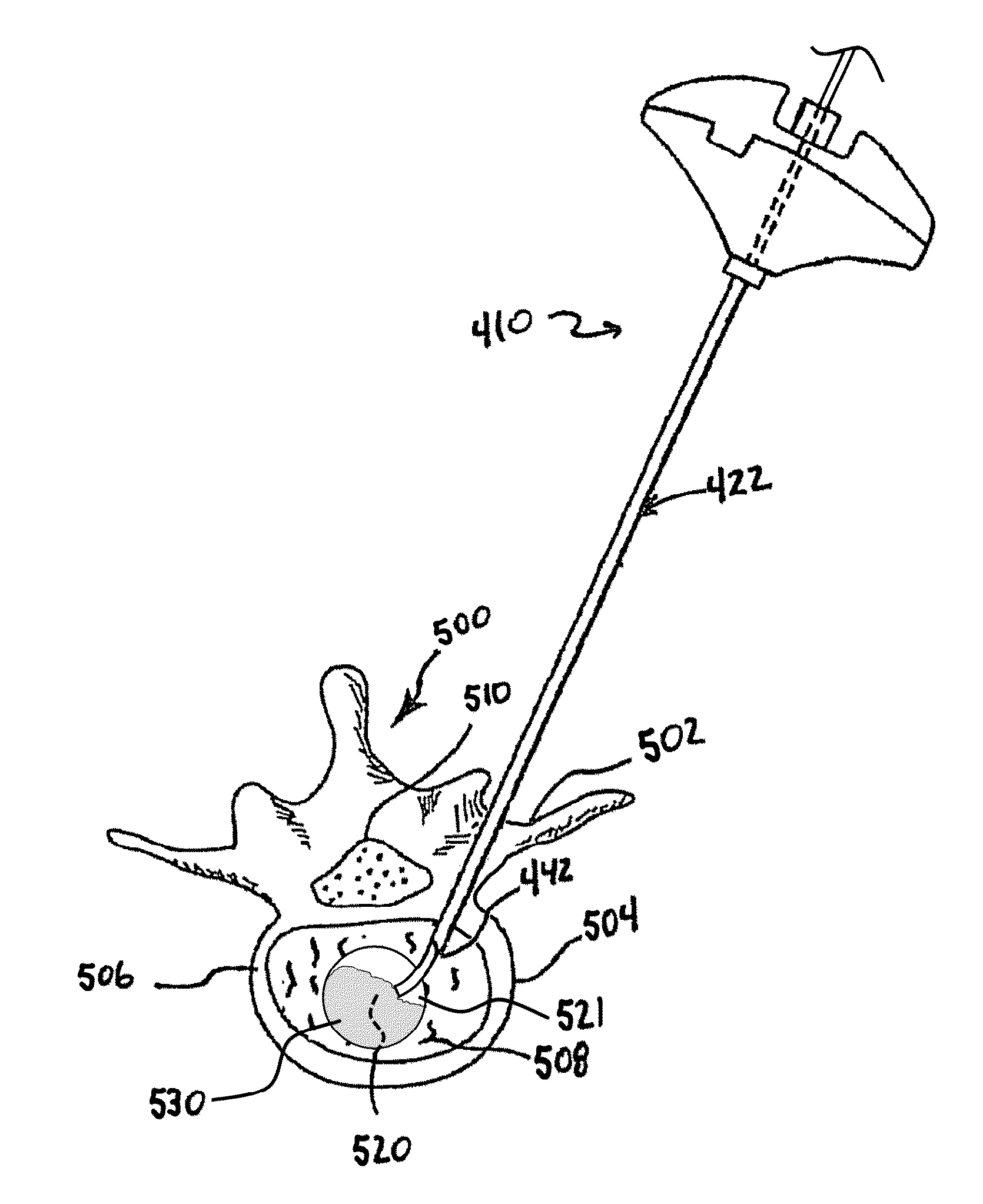 Method for balloon-aided vertebral augmentation