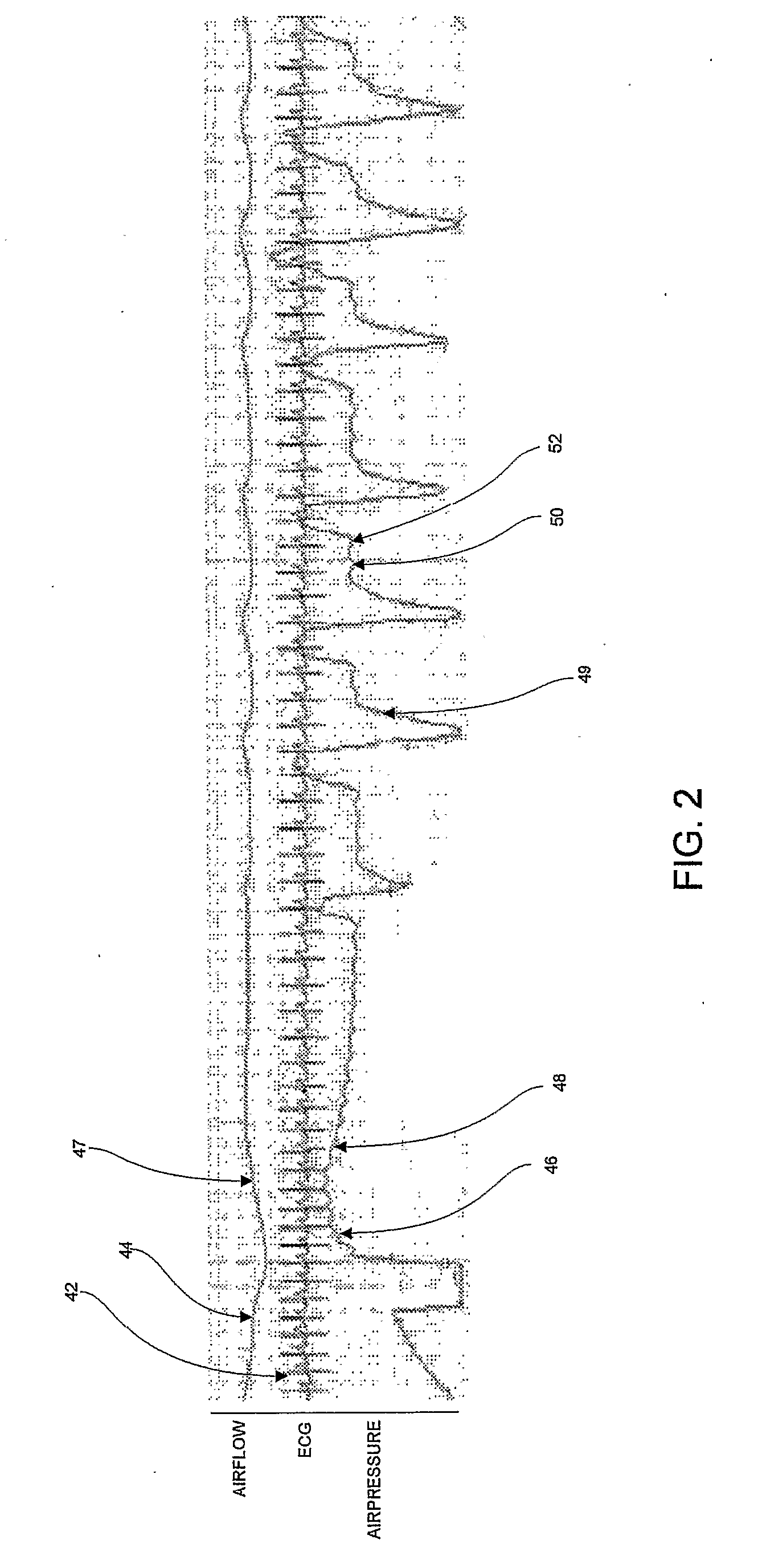 Cardiac Monitoring And Therapy Using A Device For Providing Pressure Treatment Of Sleep Disordered Breathing
