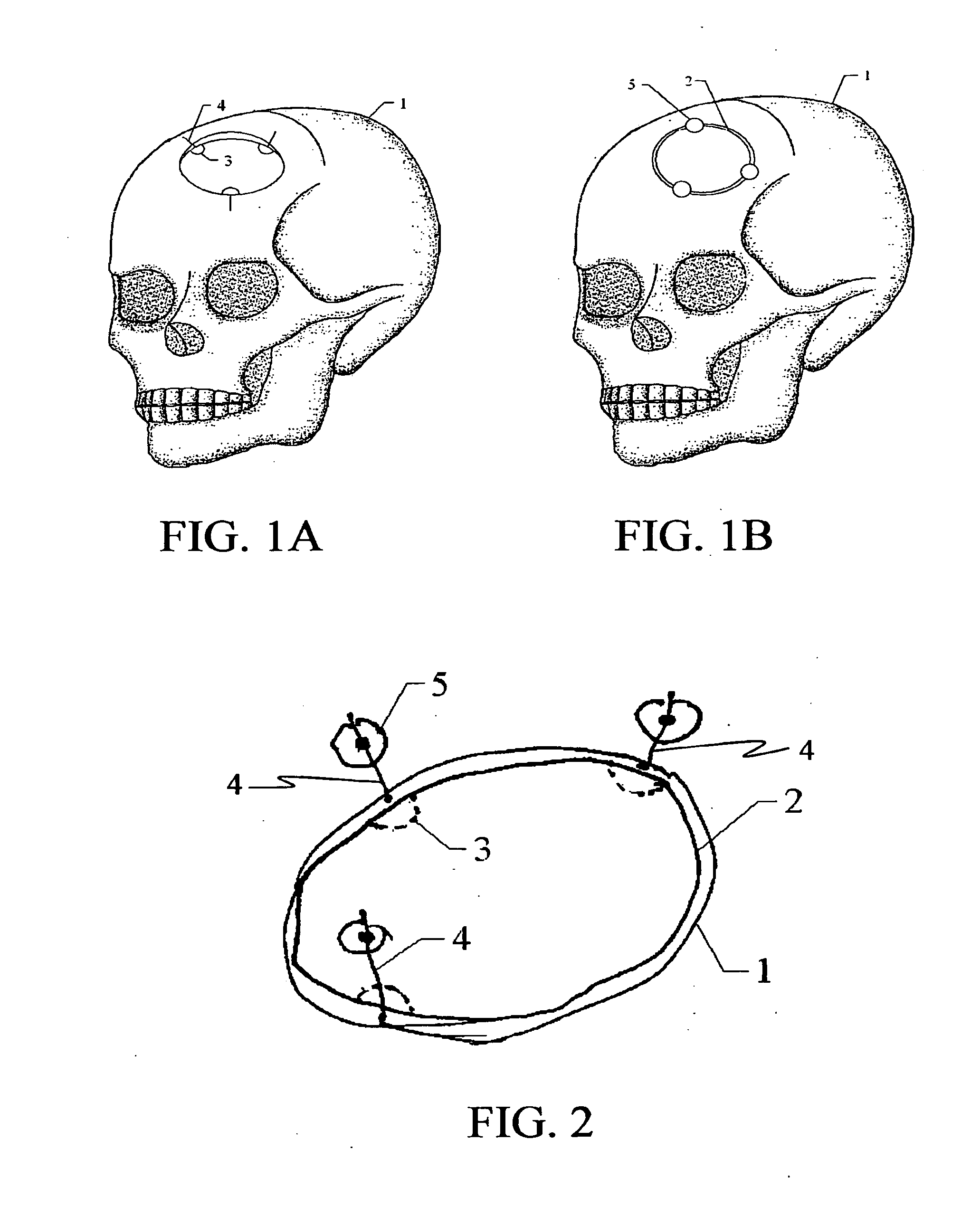 Closure Device for Skull Plates and Related Method Thereof