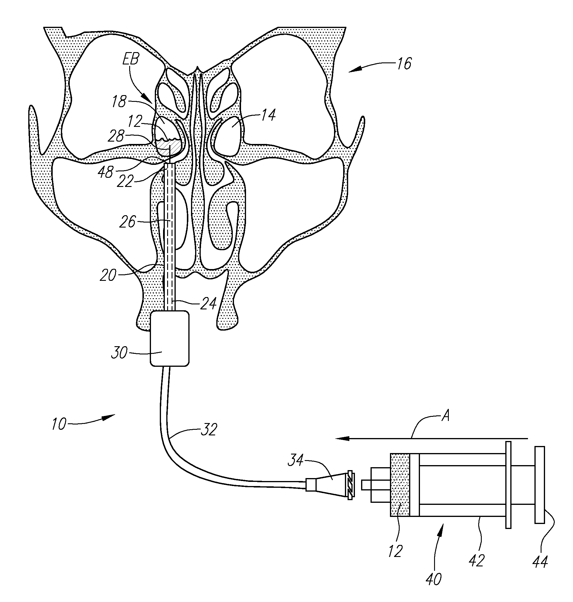 Apparatus and method for treatment of ethmoids