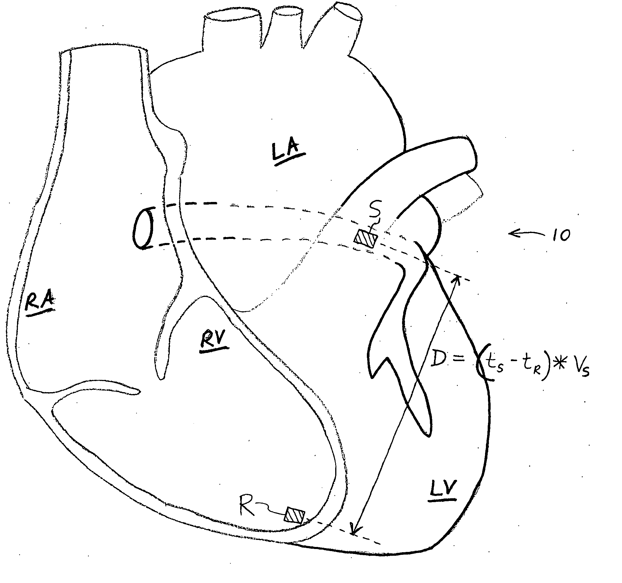 Method and apparatus for evaluating ventricular performance during isovolumic contraction