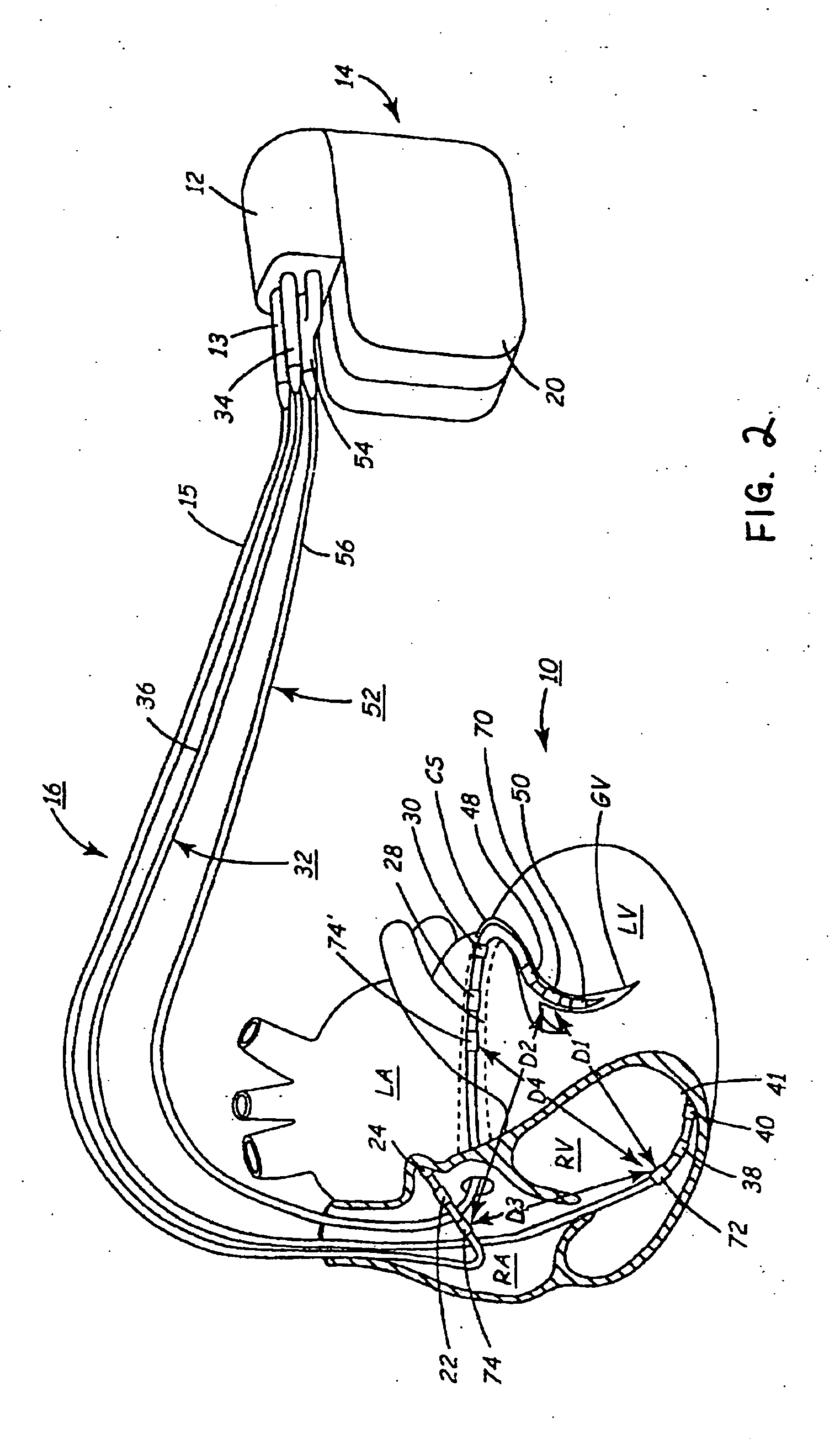 Method and apparatus for evaluating ventricular performance during isovolumic contraction