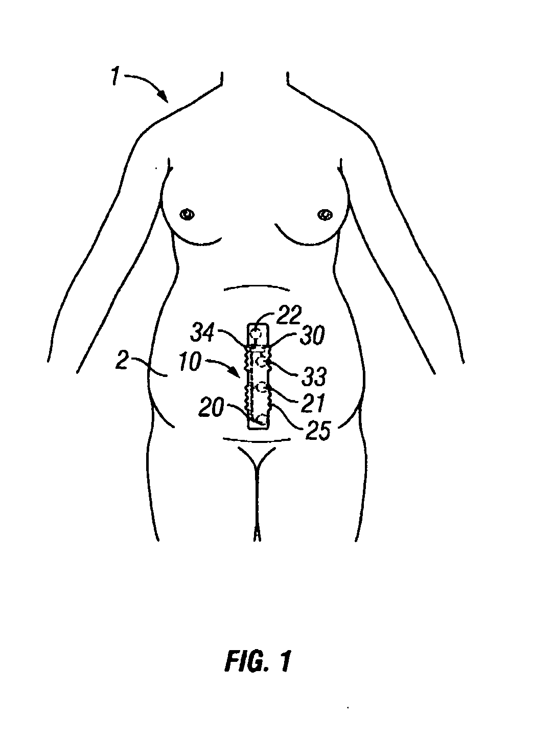Intrapartum monitor patch
