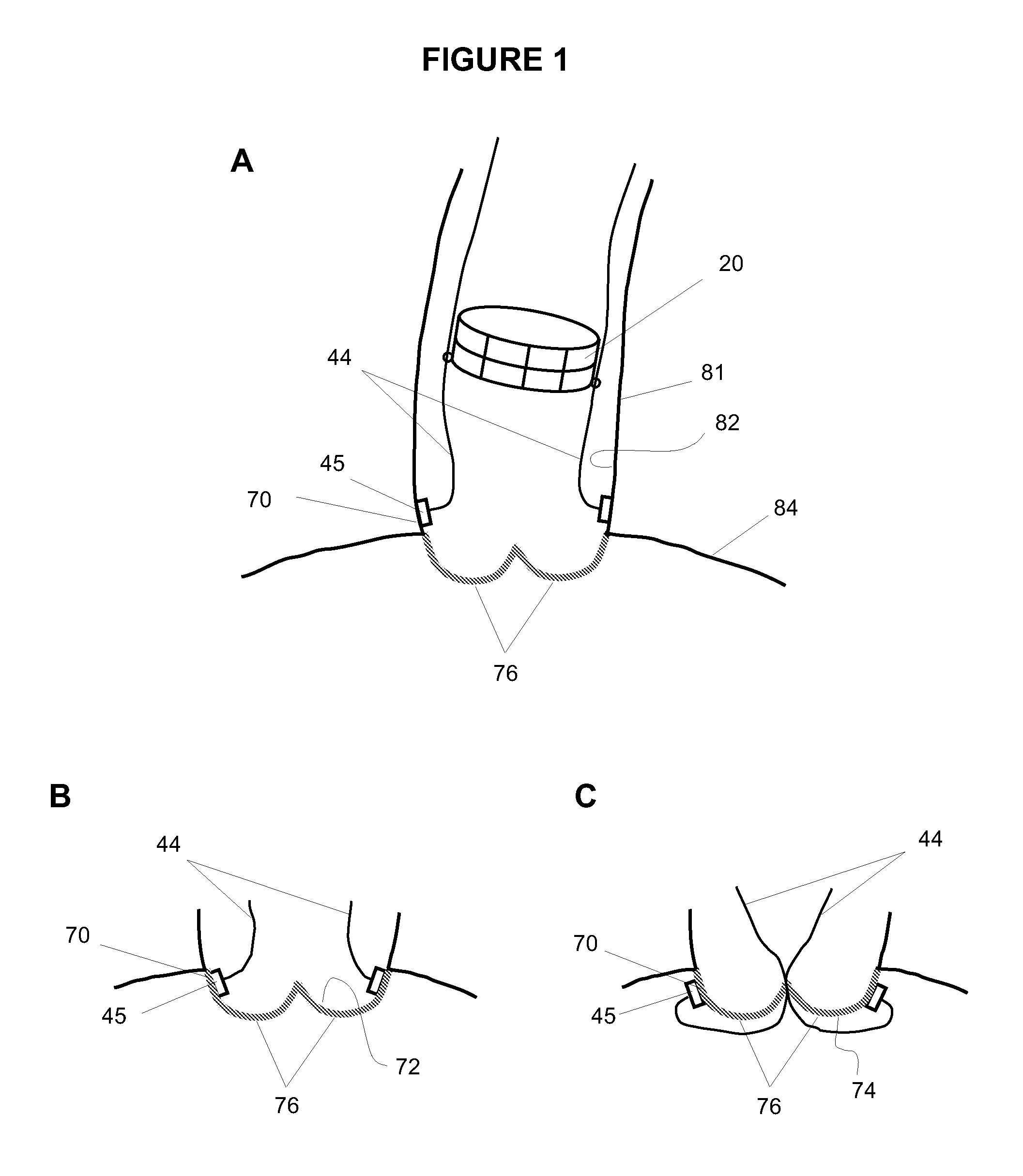 System and method for placing a percutaneous valve device