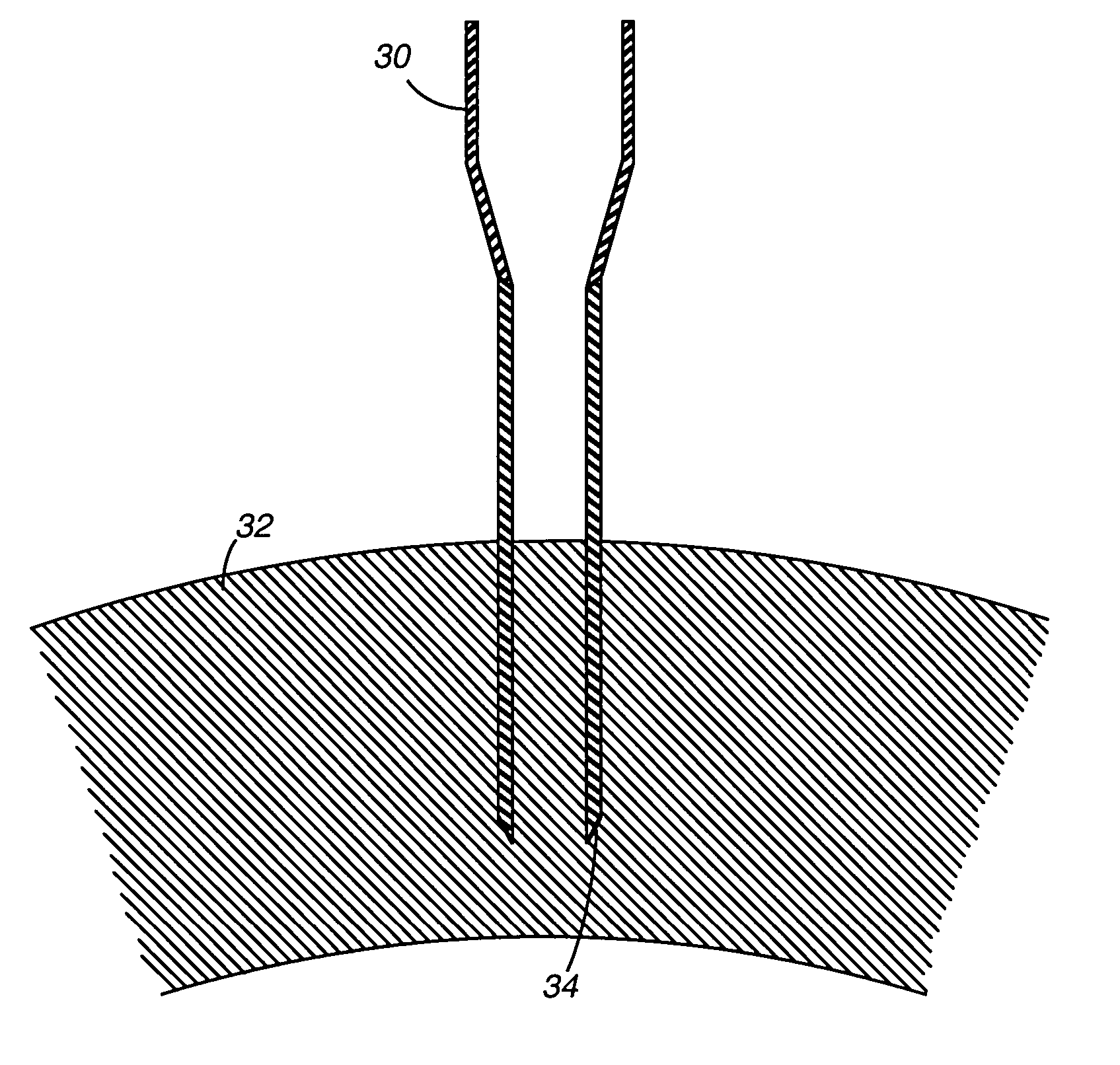 Method and apparatus for providing immediate supplemental blood flow to an organ
