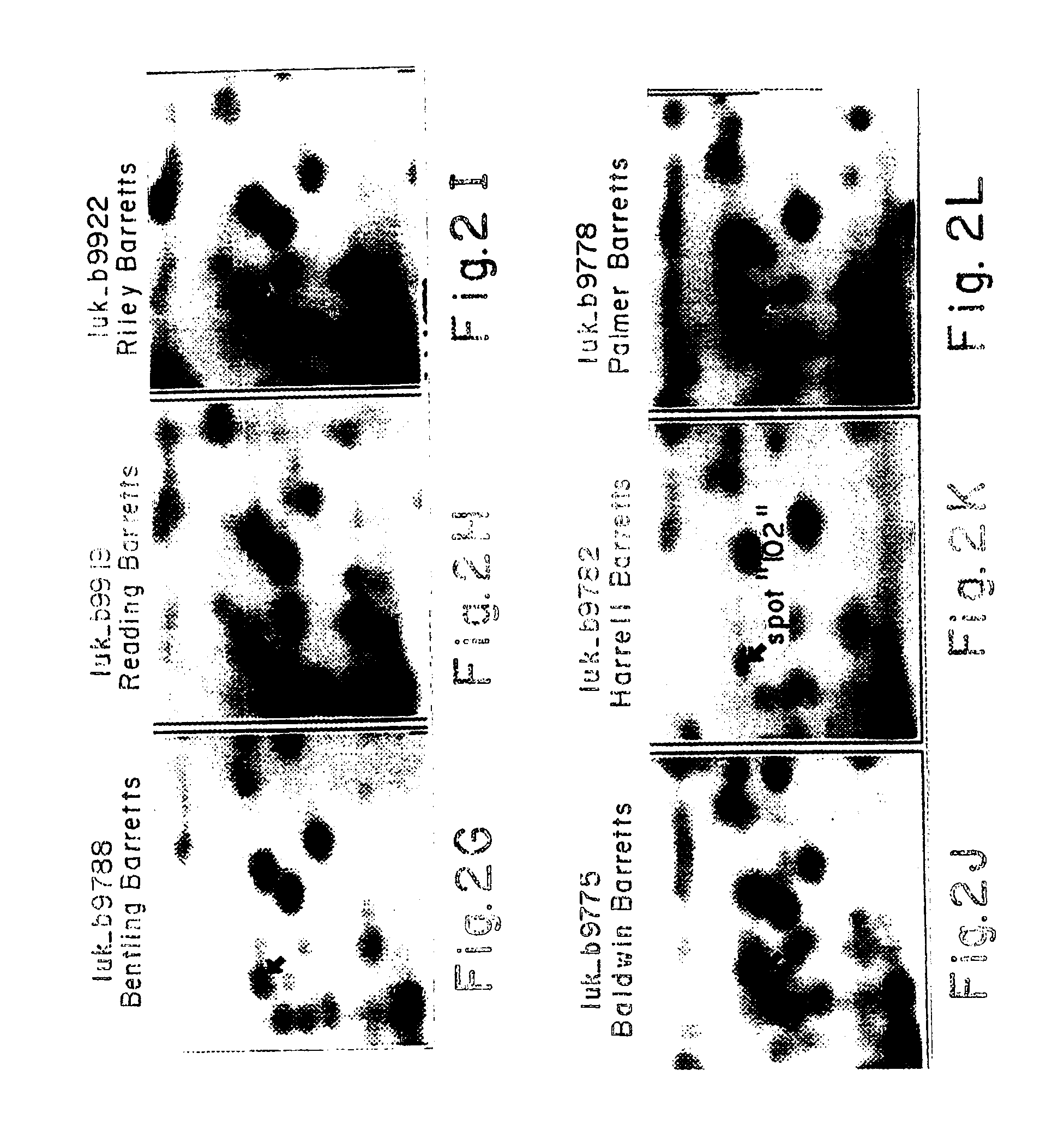 Protein markers for esophageal cancer