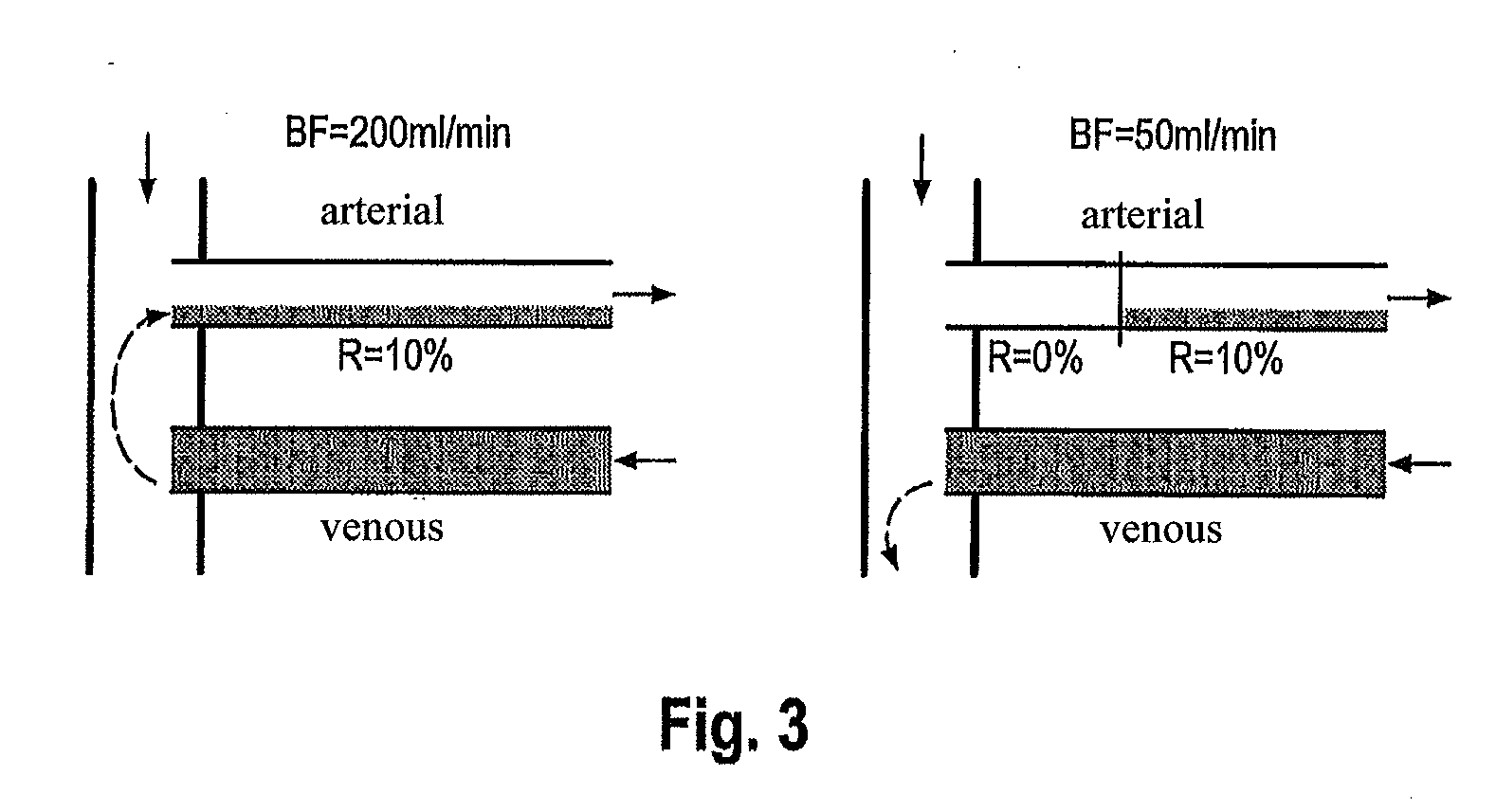 Method of detecting recirculation in an arteriovenous shunt during ongoing hemodialysis and dialysis system