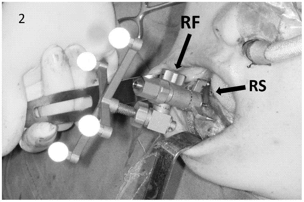 Application of digitization technology to oral approach mandibular condylar lesion surgical excision