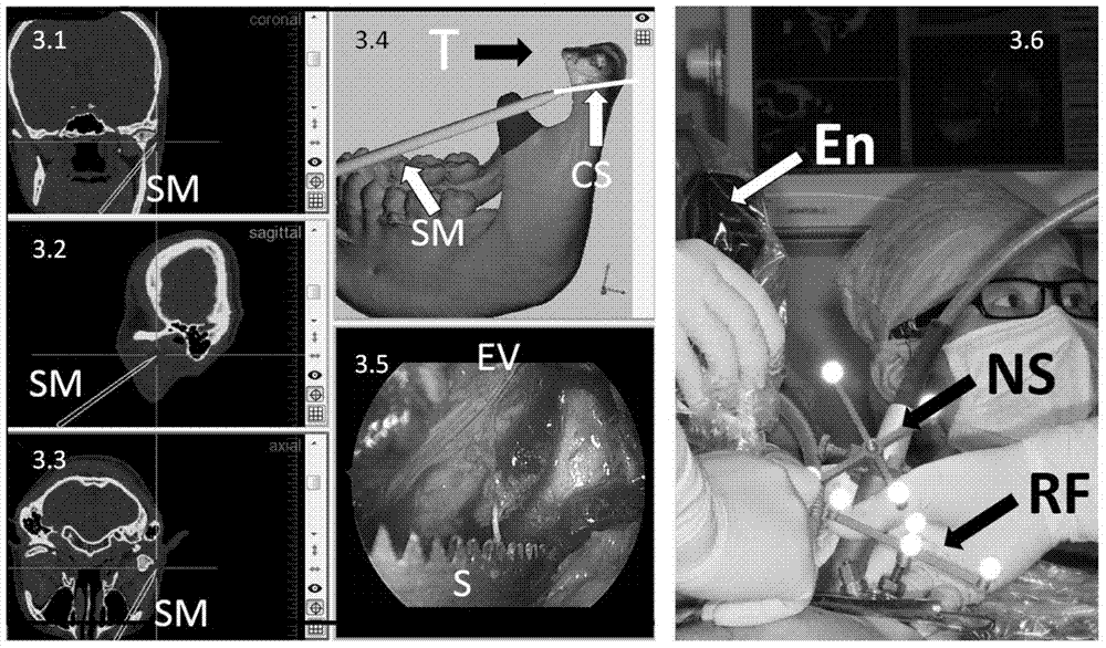 Application of digitization technology to oral approach mandibular condylar lesion surgical excision