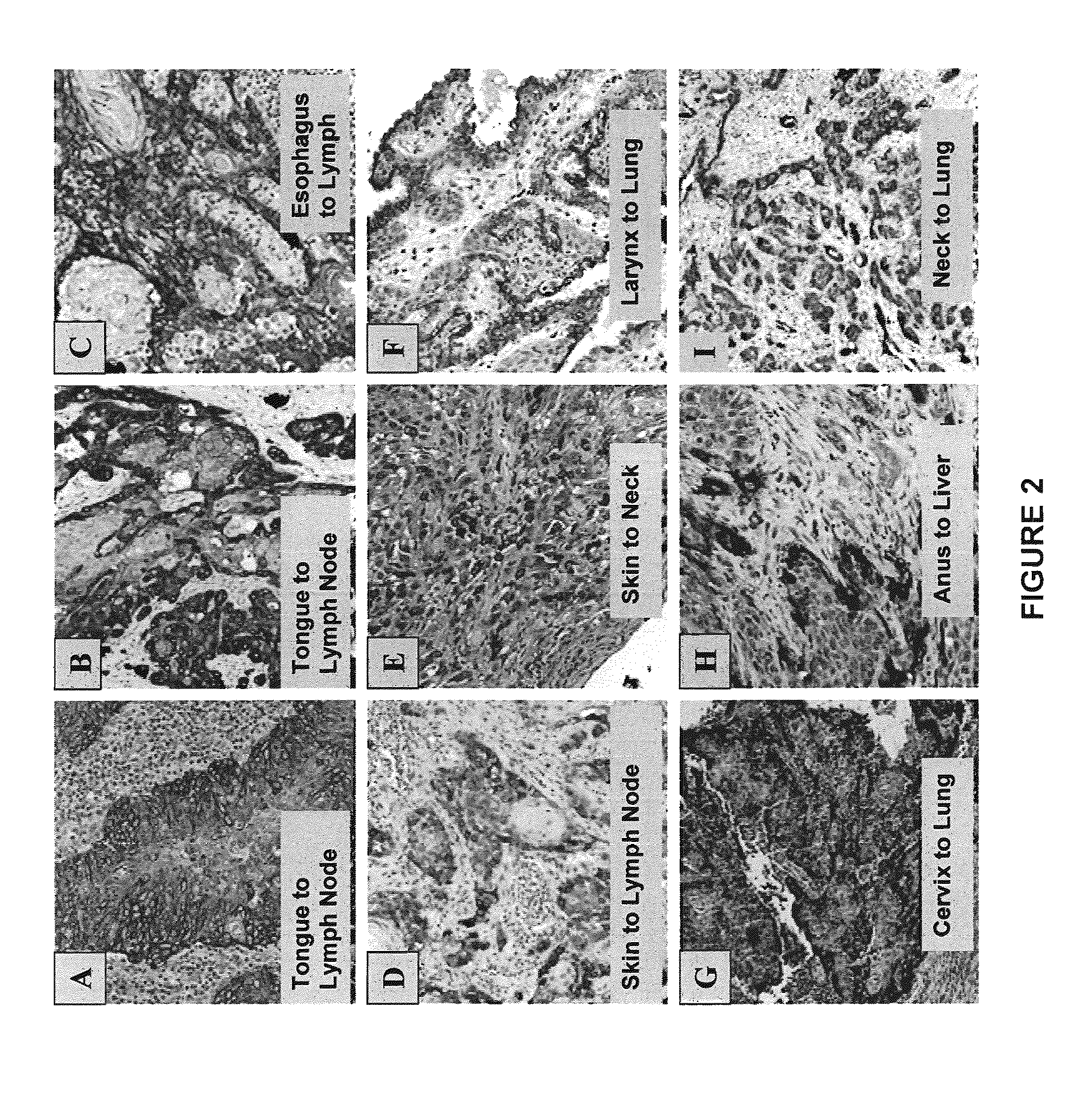 Compositions and Methods for Inhibiting Growth of SMAD-4 Deficient Cancers