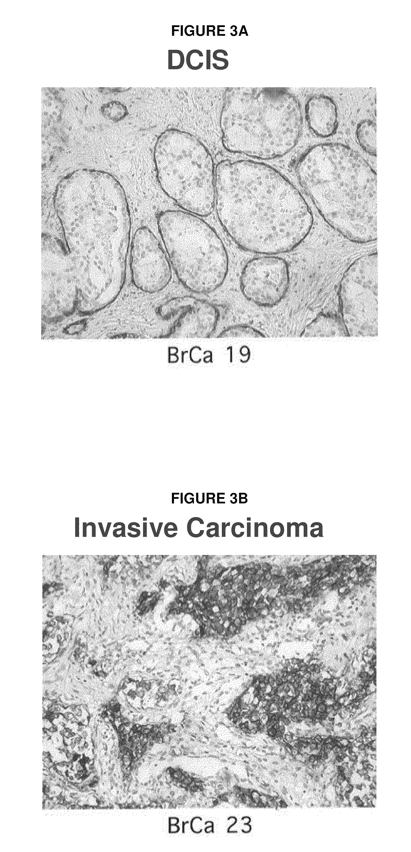 Compositions and Methods for Inhibiting Growth of SMAD-4 Deficient Cancers