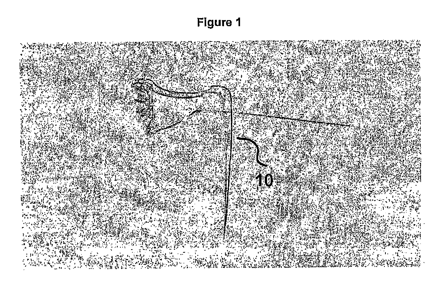 Method and device for the controlled delivery and placement of securing elements in a body