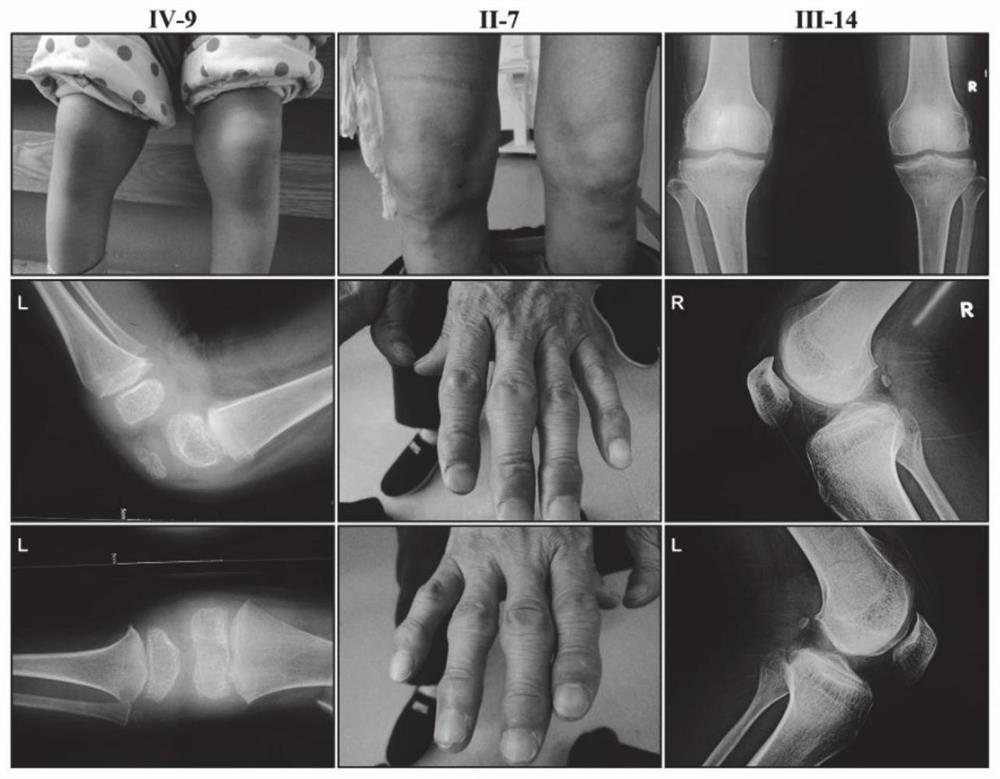 Application of Smoc2 gene and SNP marker thereof in multiple epiphyseal dysplasia