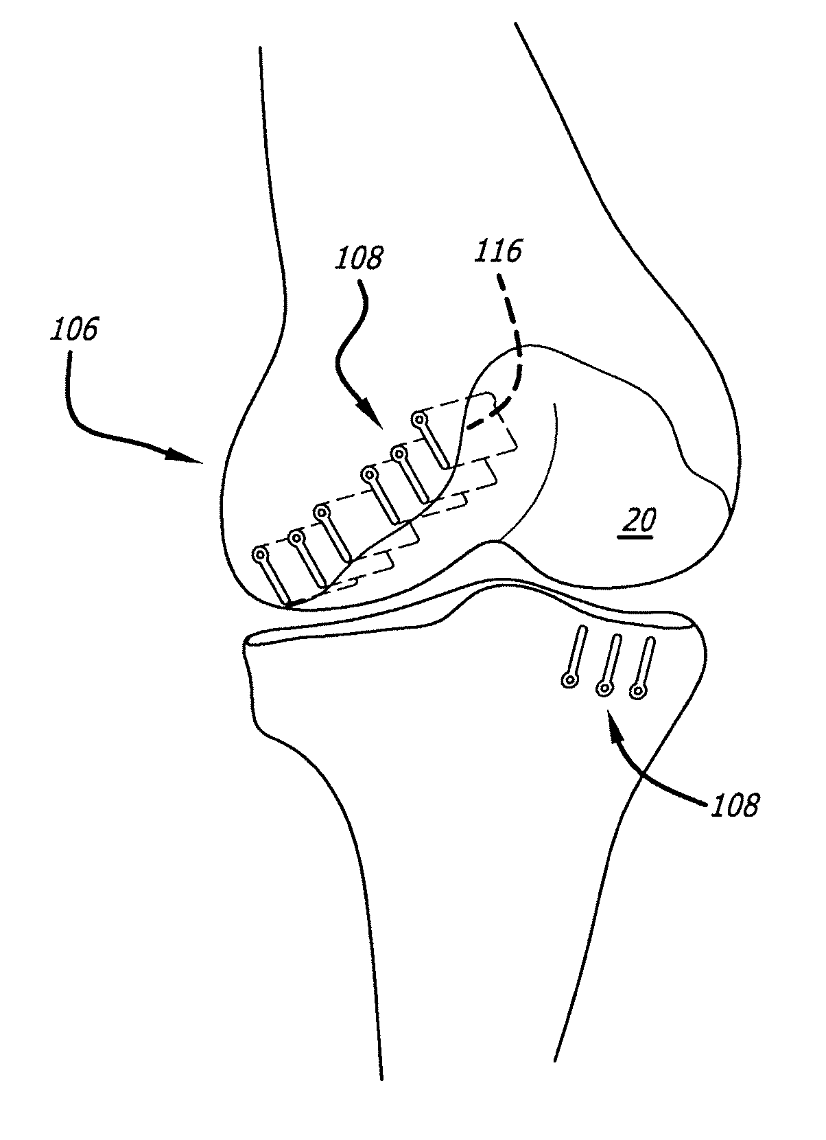 Joint support and subchondral support system