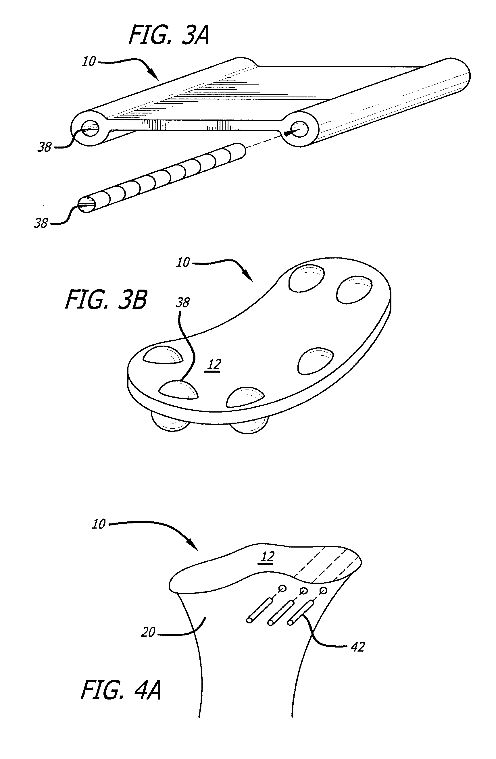 Joint support and subchondral support system