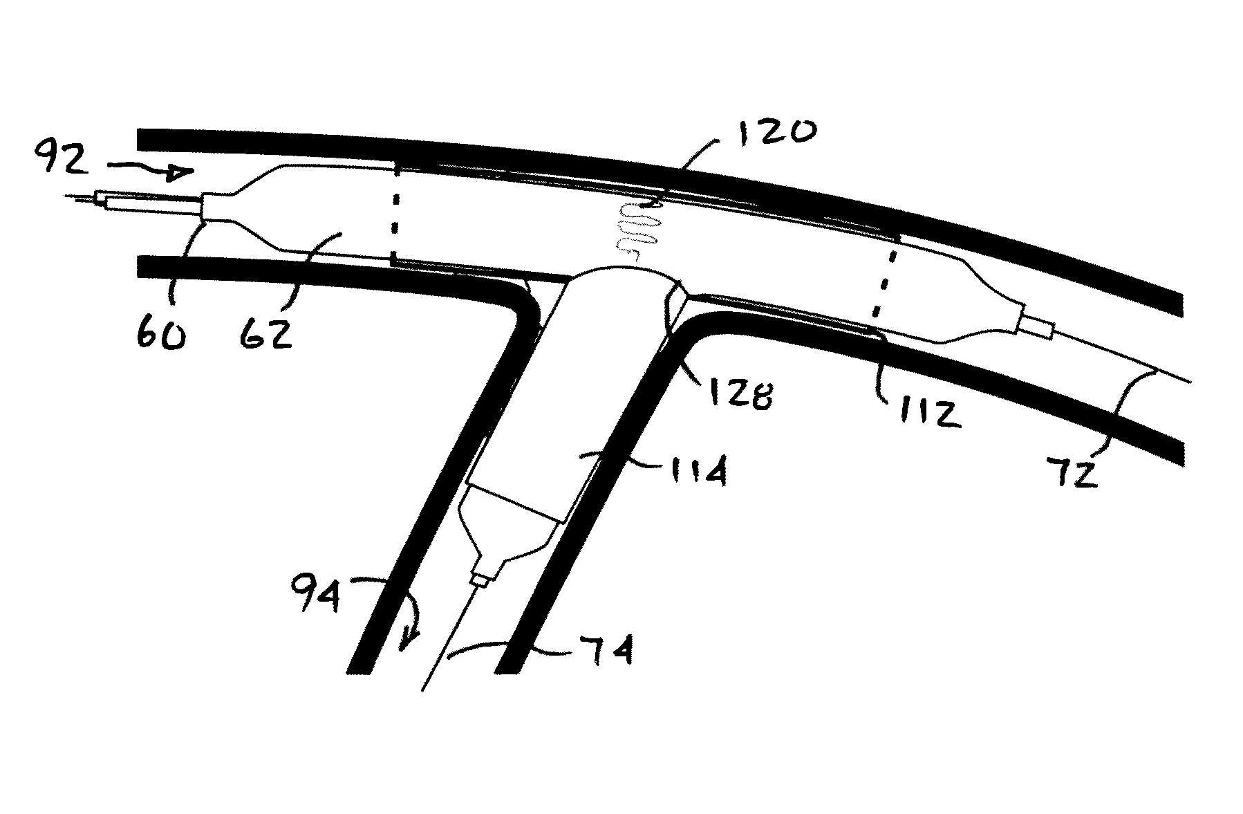 Stent system, deployment apparatus and method for bifurcated lesion