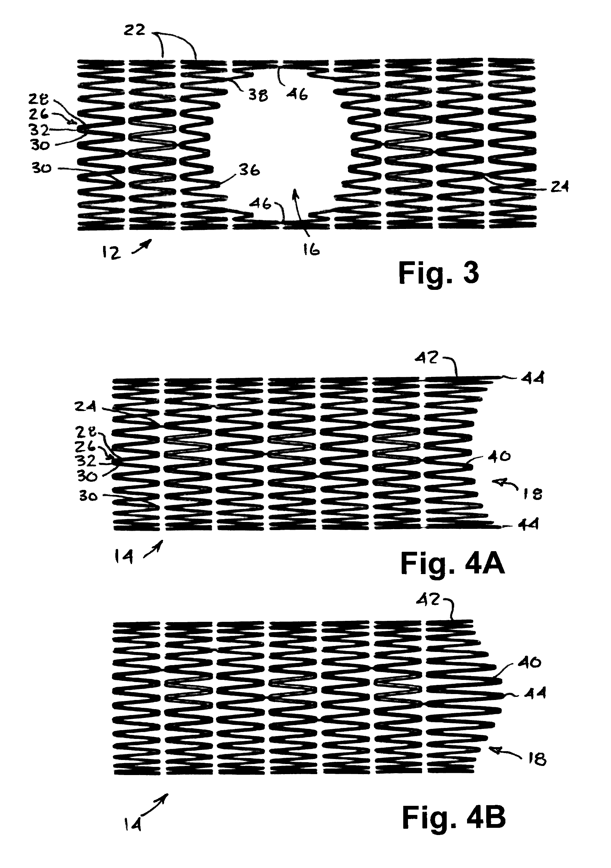 Stent system, deployment apparatus and method for bifurcated lesion