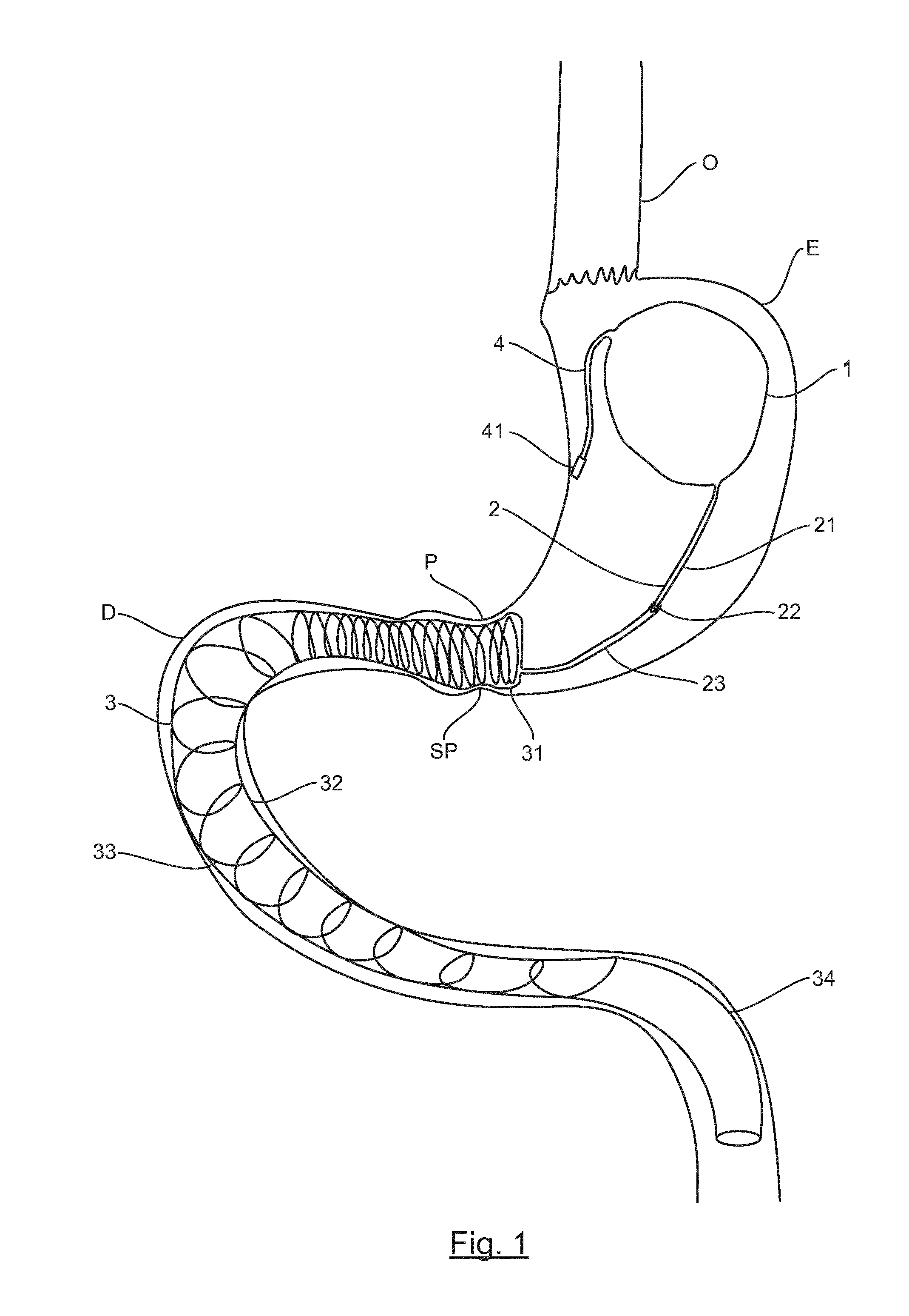Implantable prosthetic device for weight loss in an obese or overweight patient comprising an inflatable gastric balloon and a duodenal prosthesis
