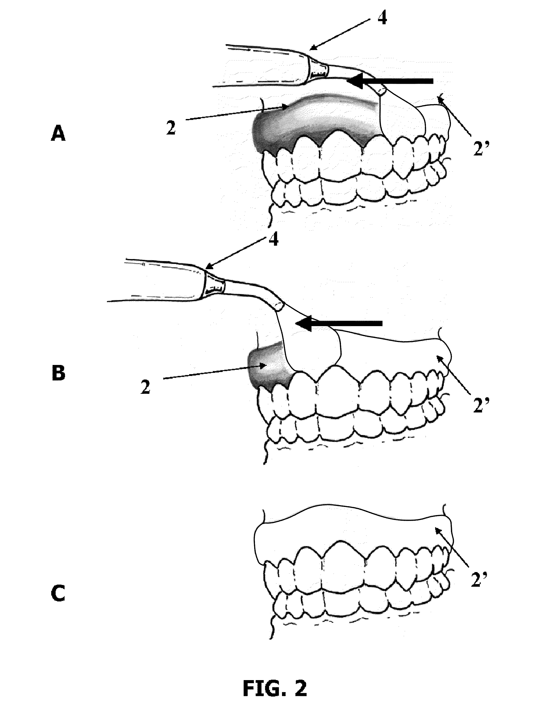Composition for dental barrier comprising at least one monomer, at least one polymerization initiating system, and at least one indicator enabling the polymerization reaction to be monitored