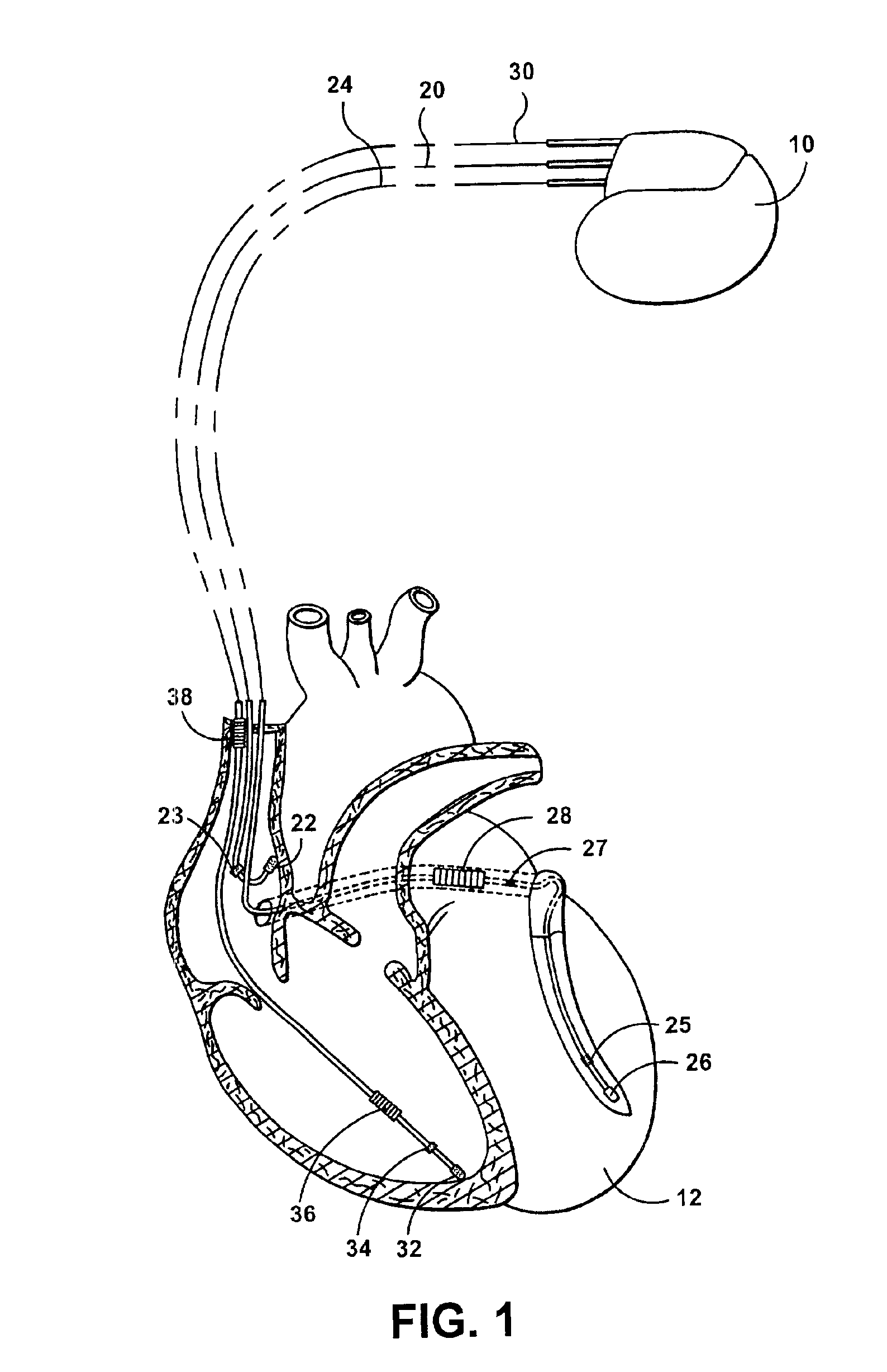 Implantable stimulation device and method for performing inter-chamber conduction search and conduction time measurement