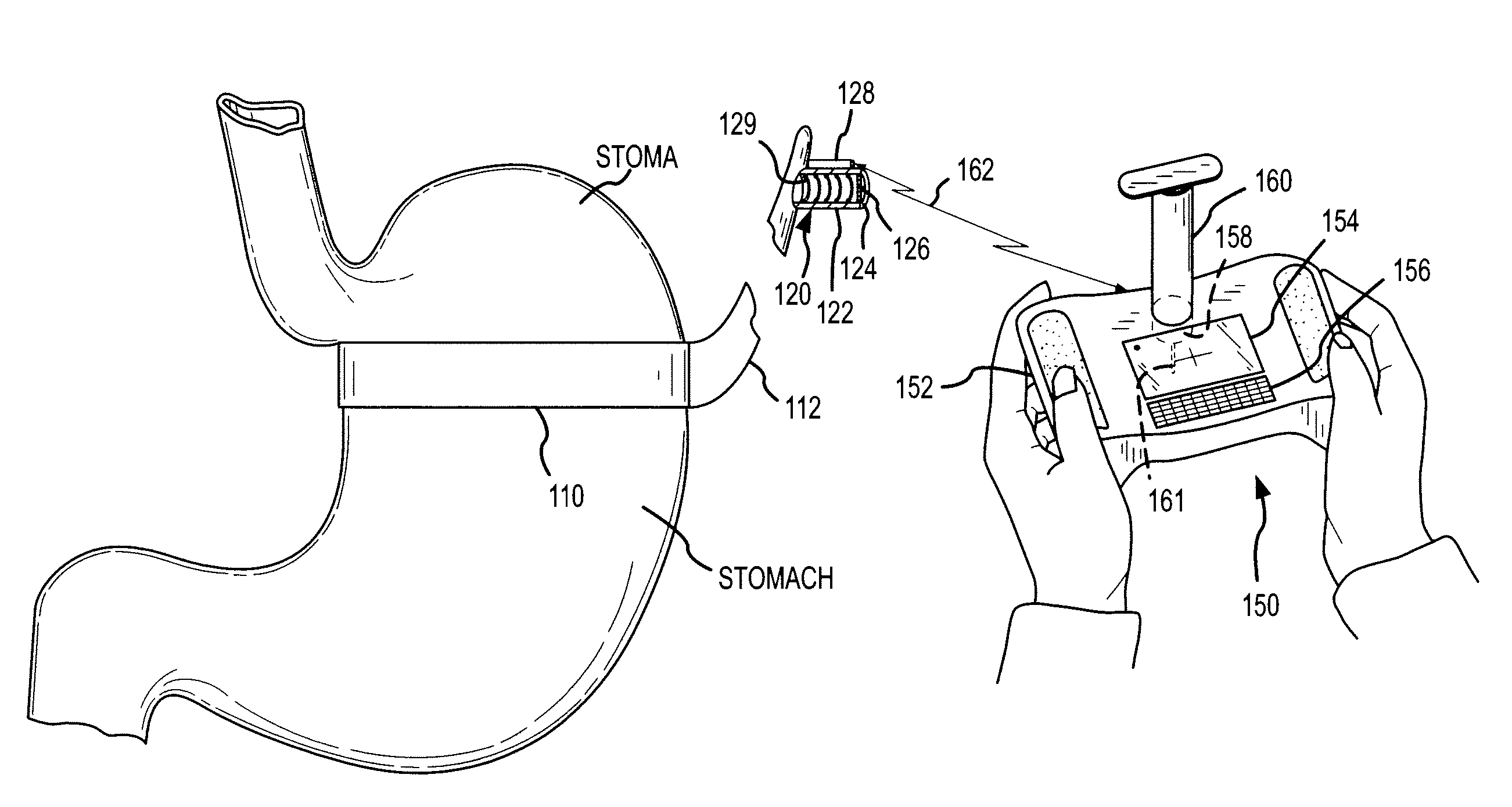 Method for locating an implanted fluid access port