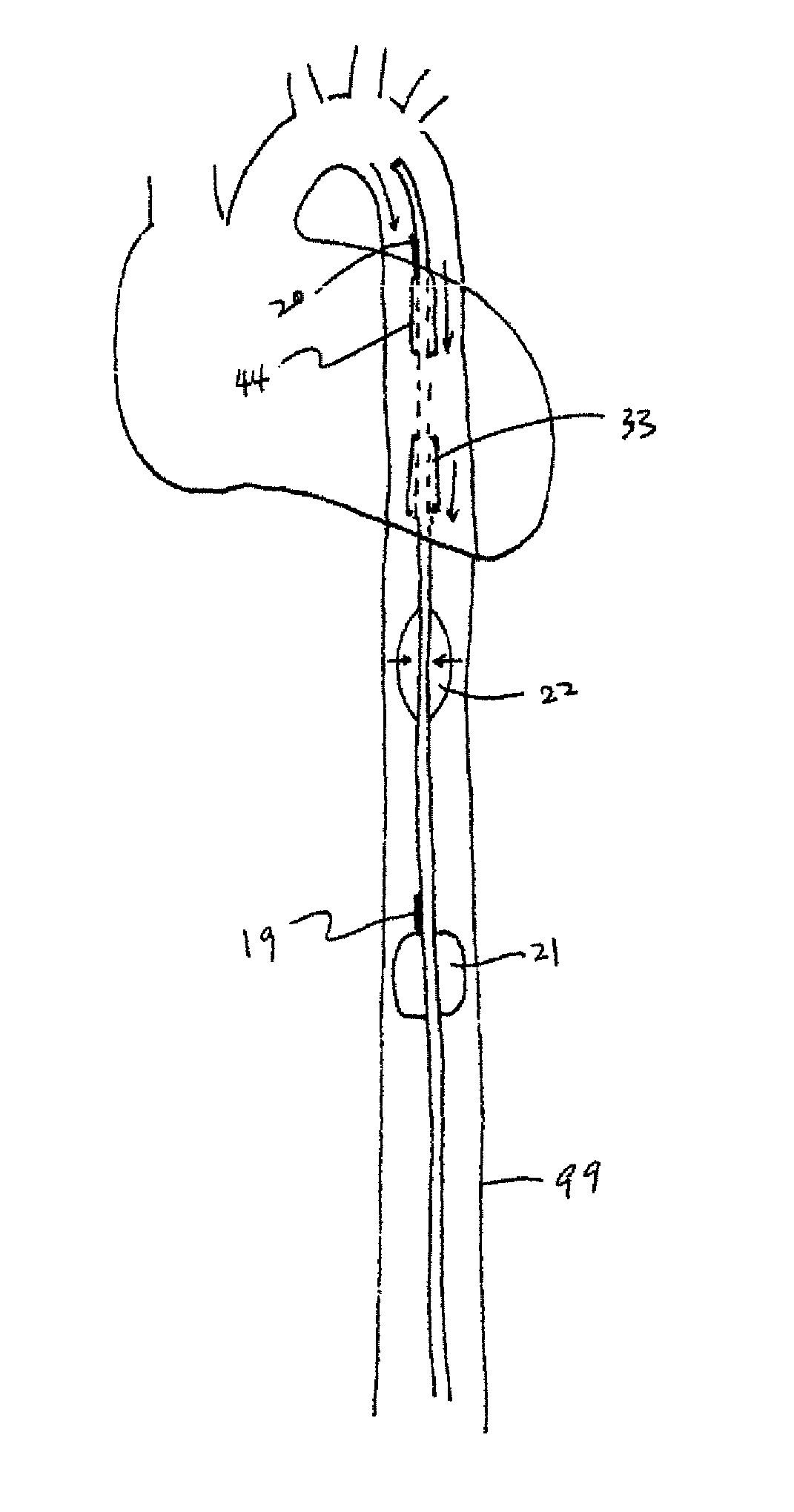 Counterpulsation device with increased volume-displacement efficiency and methods of use